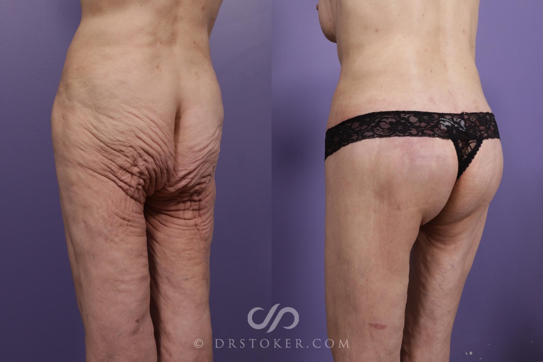 Before & After Bikini Body Lift ™ Case 2456 Left Oblique View in Los Angeles, CA
