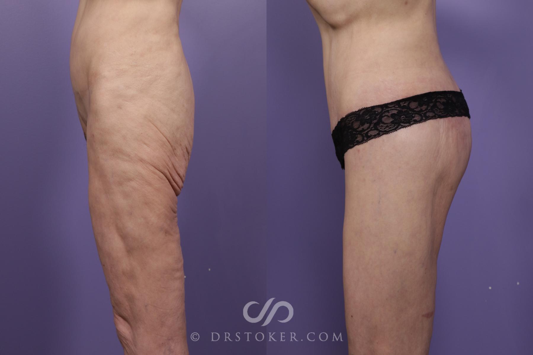 Before & After Bikini Body Lift ™ Case 2456 Left Side View in Los Angeles, CA