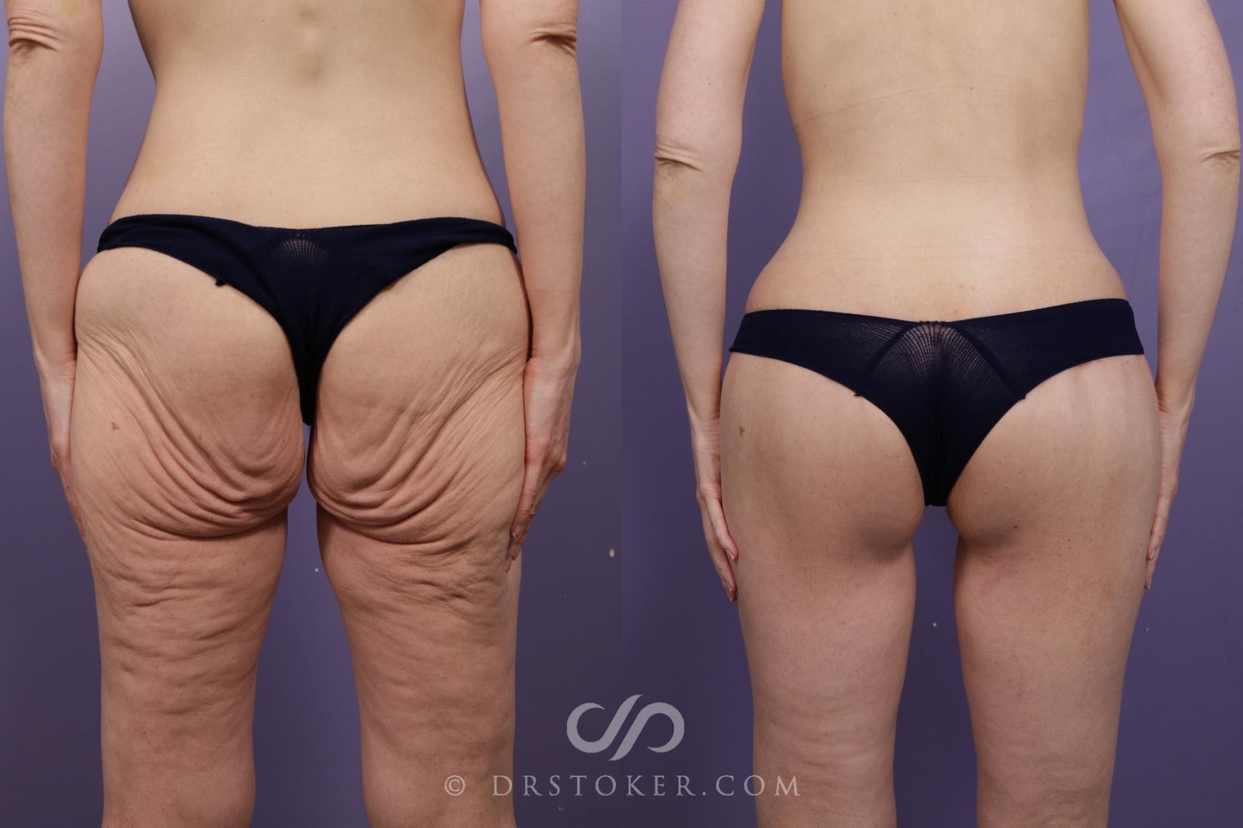 Before & After Bikini Body Lift ™ Case 2457 Back View in Los Angeles, CA