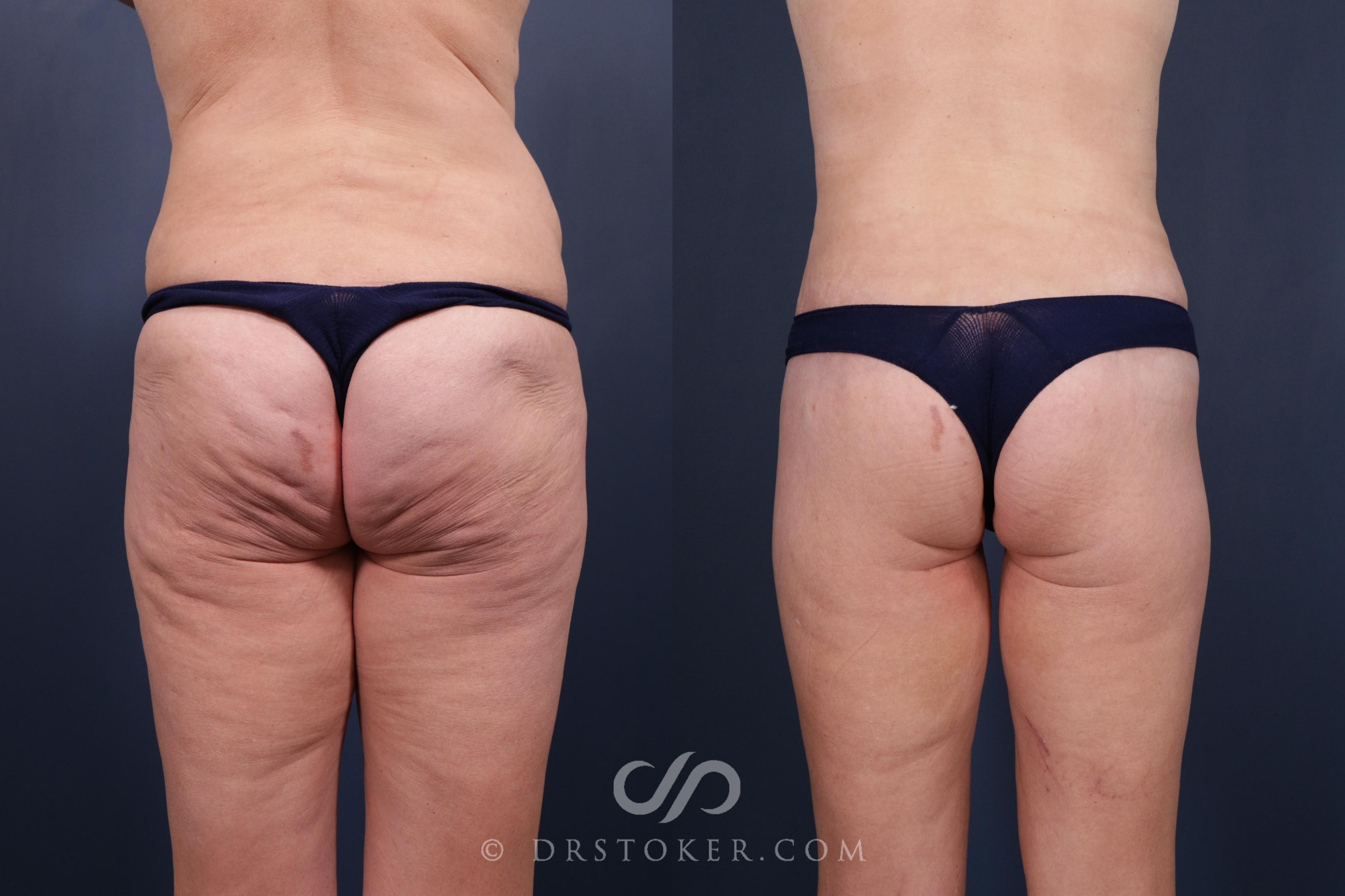 Before & After Bikini Body Lift ™ Case 2459 Back View in Los Angeles, CA