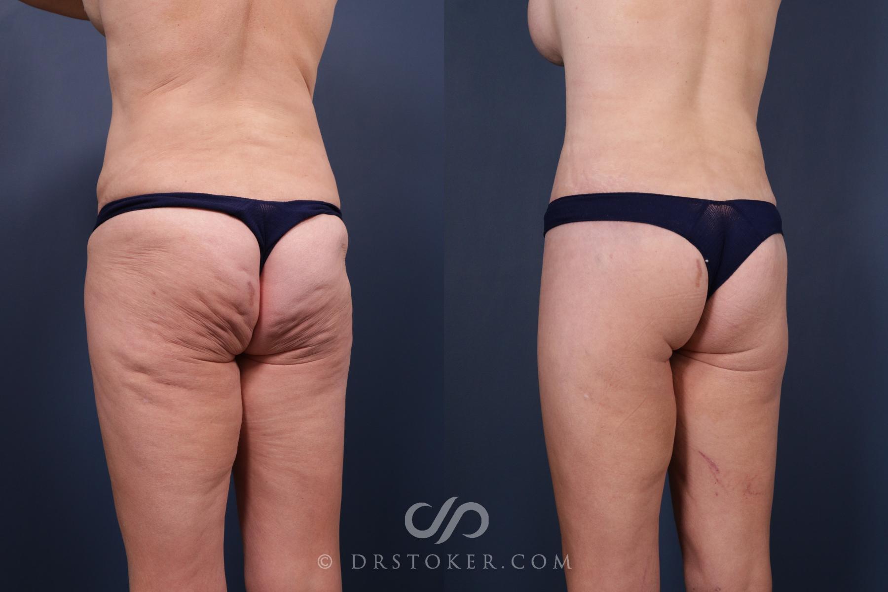 Before & After Bikini Body Lift ™ Case 2459 Left Oblique View in Los Angeles, CA