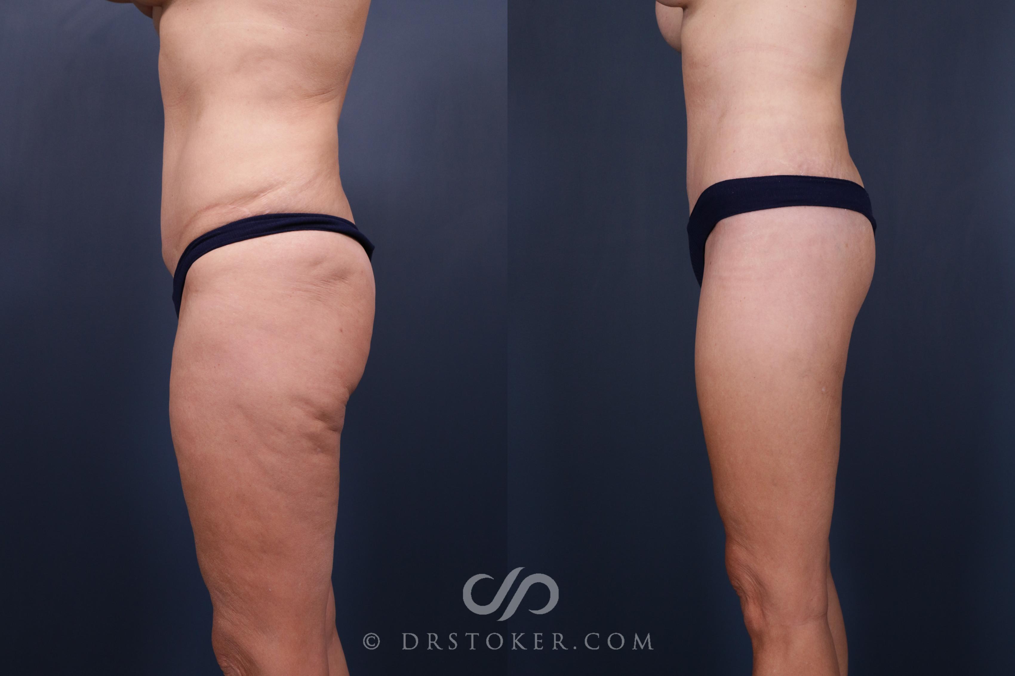 Before & After Bikini Body Lift ™ Case 2459 Left Side View in Los Angeles, CA