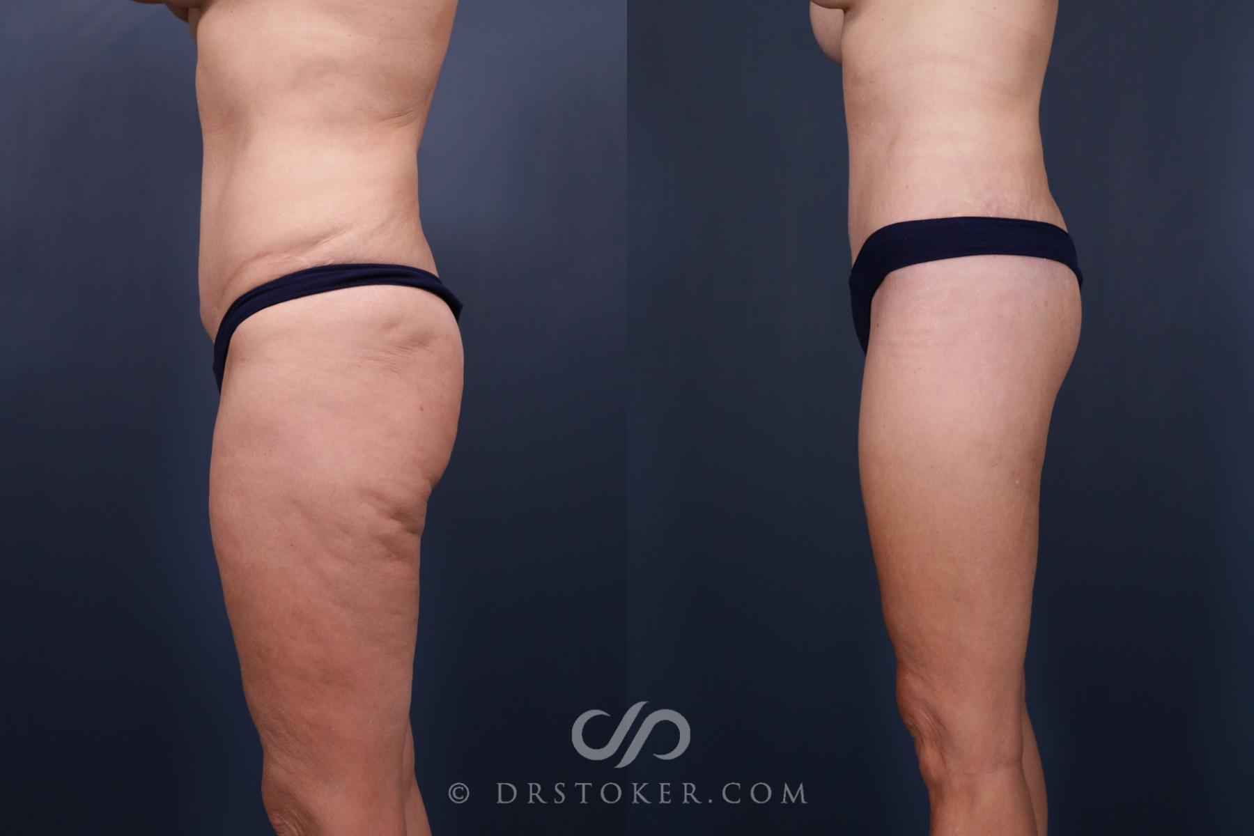 Before & After Bikini Body Lift ™ Case 2459 Left Side View in Los Angeles, CA