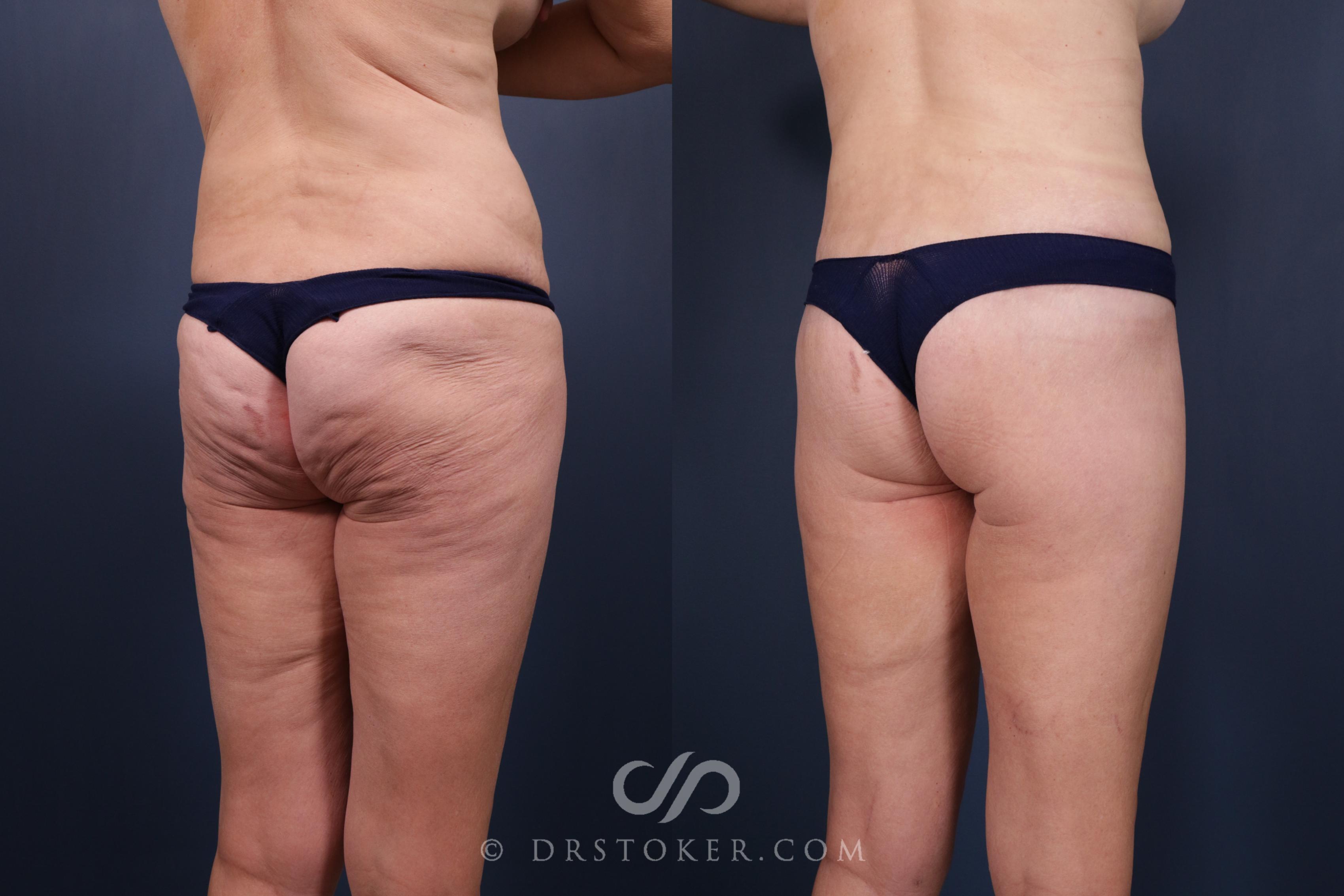 Before & After Bikini Body Lift ™ Case 2459 Right Oblique View in Los Angeles, CA