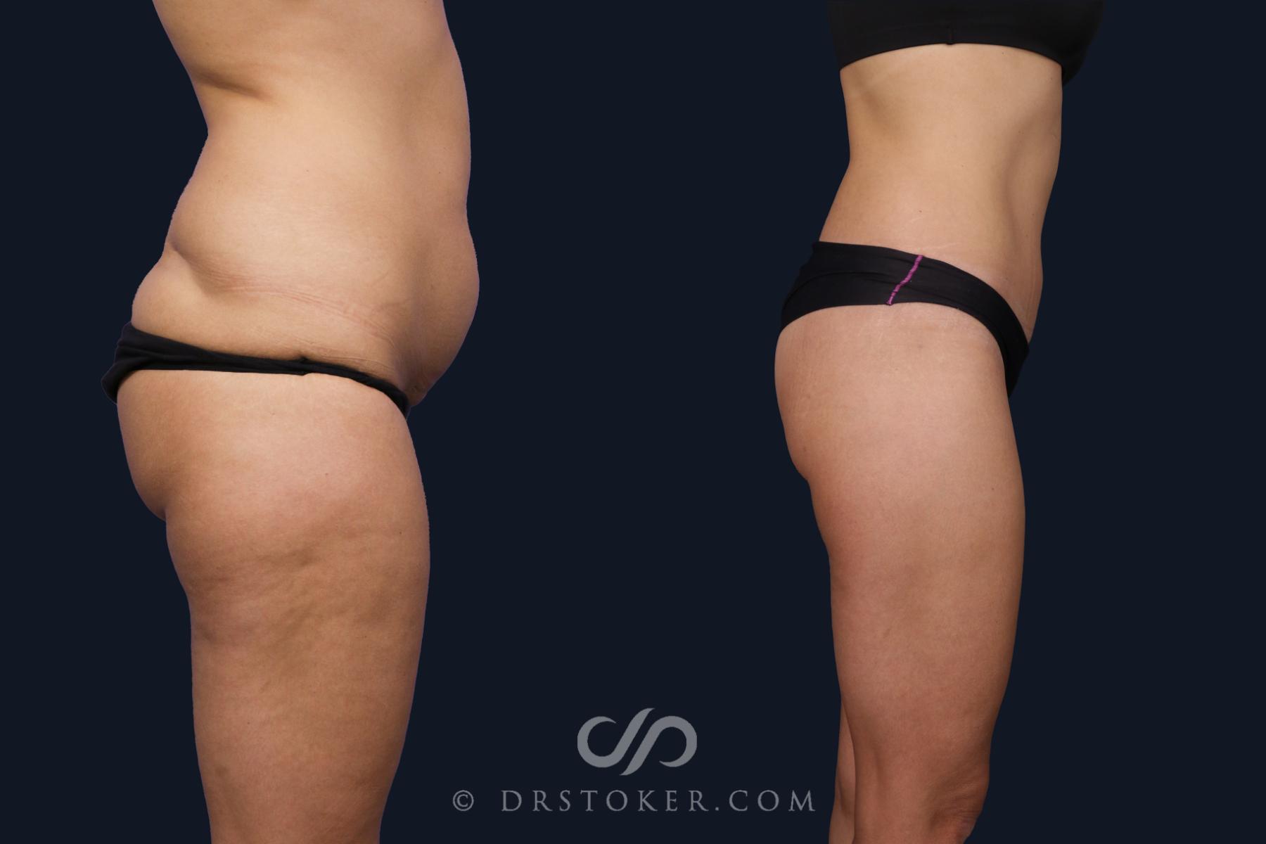Before & After Bikini Body Lift ™ Case 2460 Right Side View in Los Angeles, CA