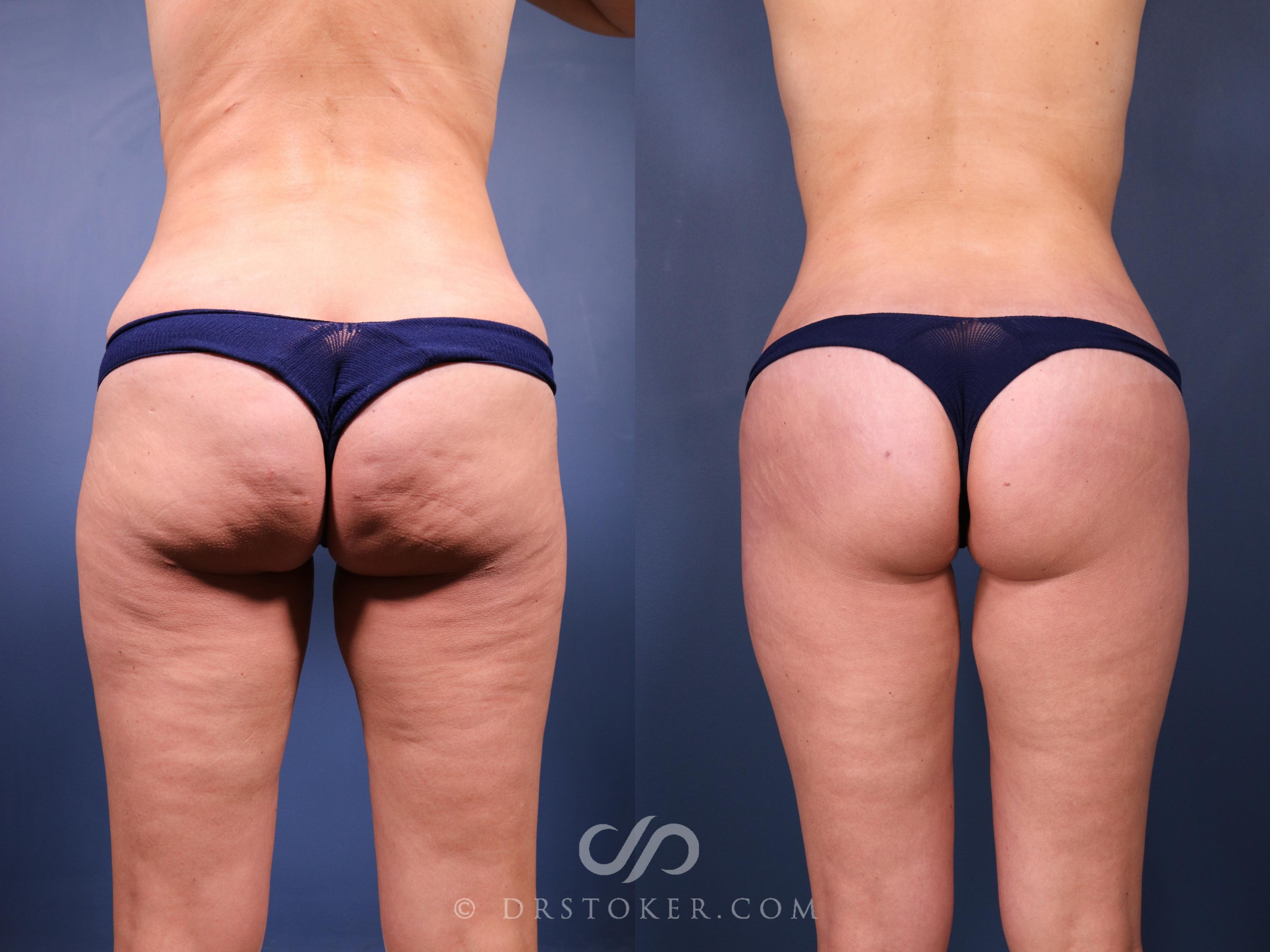 Before & After Bikini Body Lift ™ Case 2462 Back View in Los Angeles, CA