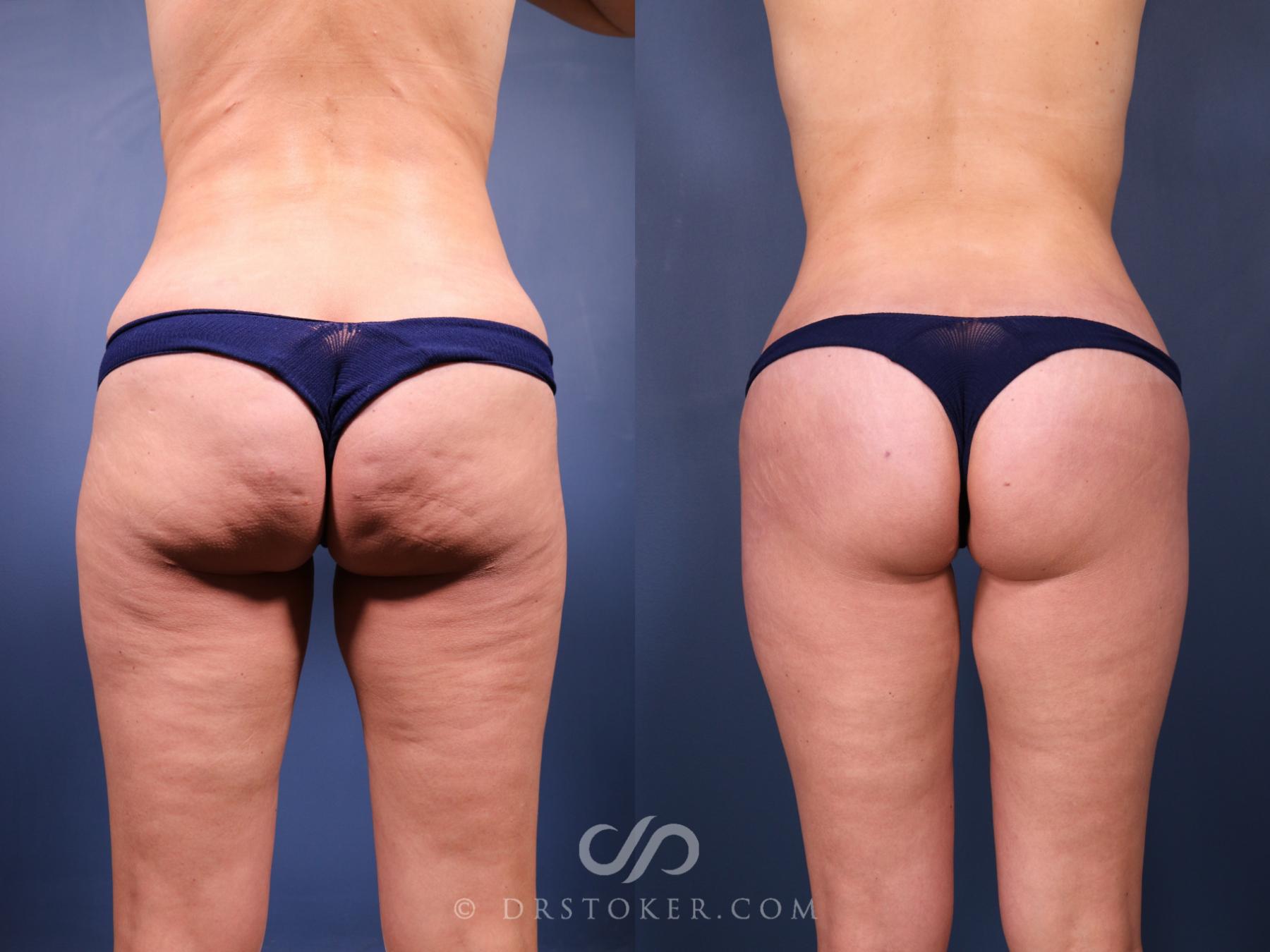 Before & After Bikini Body Lift ™ Case 2462 Back View in Los Angeles, CA