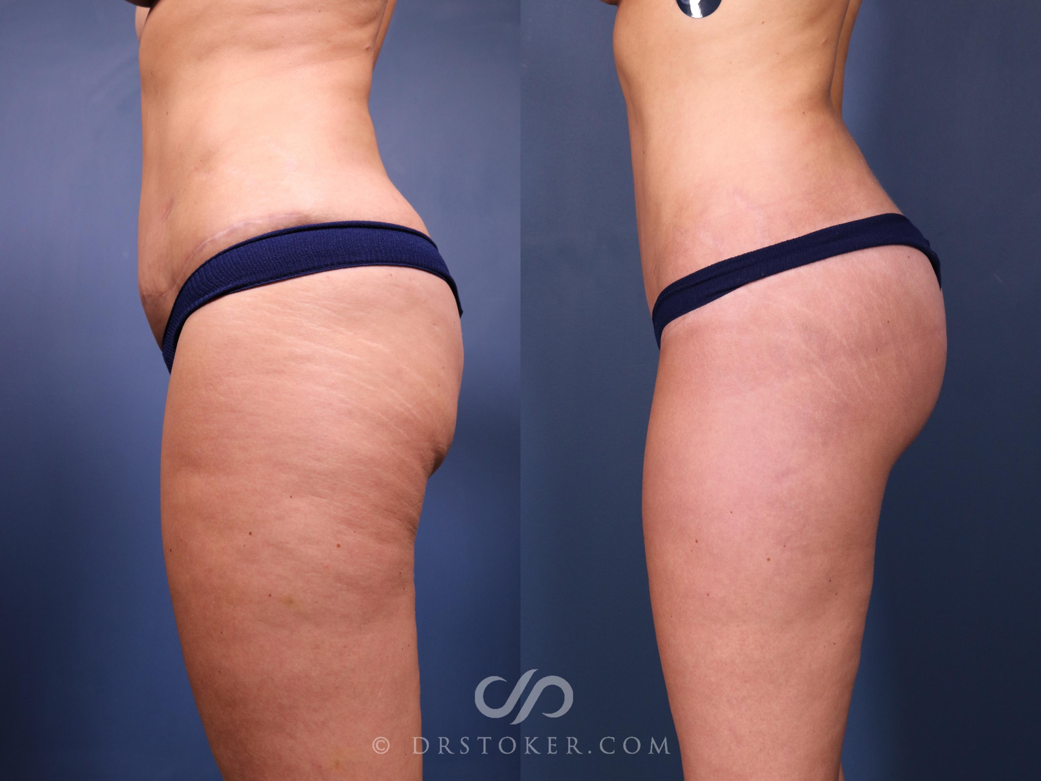 Before & After Bikini Body Lift ™ Case 2462 Left Side View in Los Angeles, CA