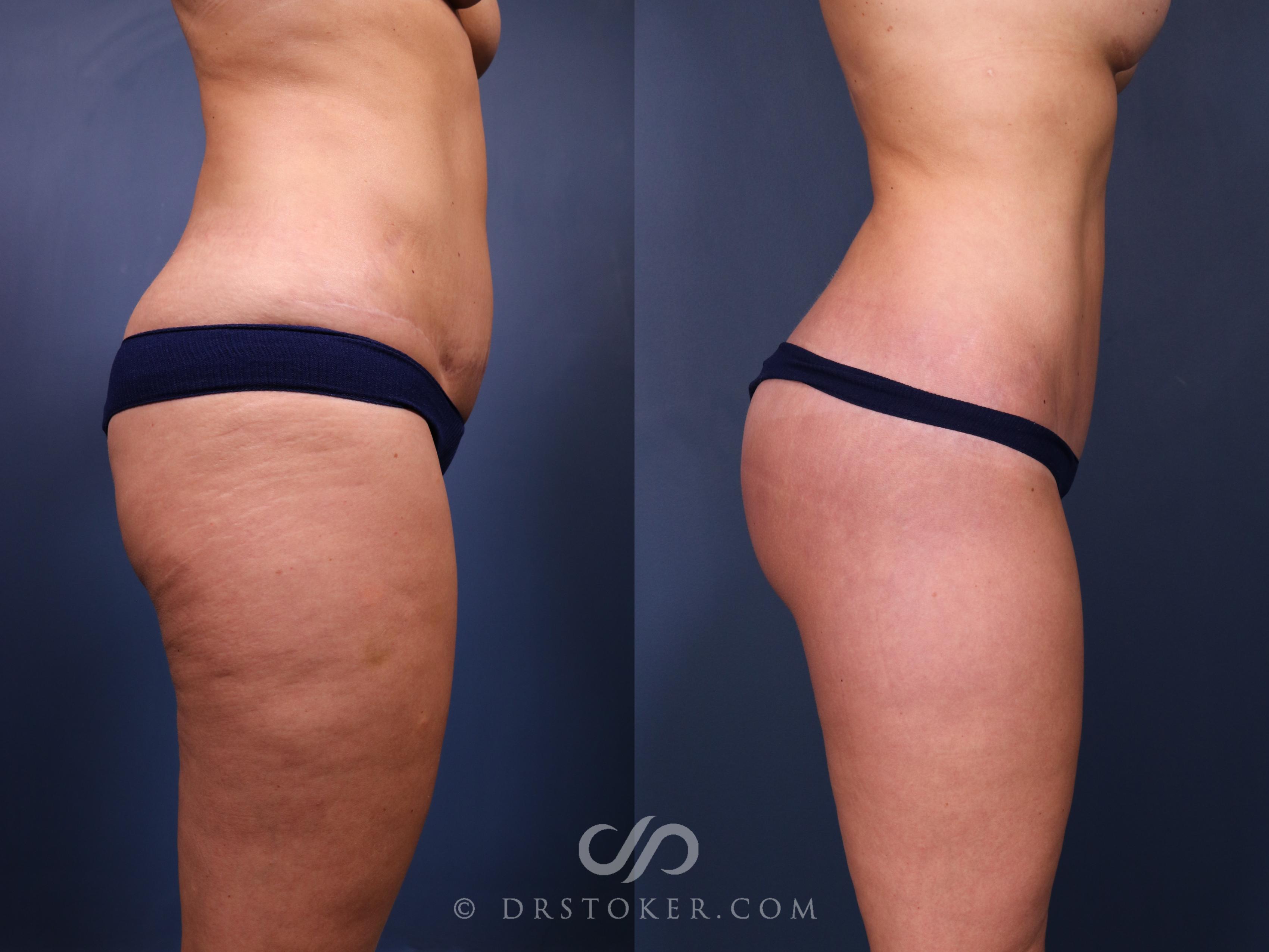 Before & After Bikini Body Lift ™ Case 2462 Right Side View in Los Angeles, CA