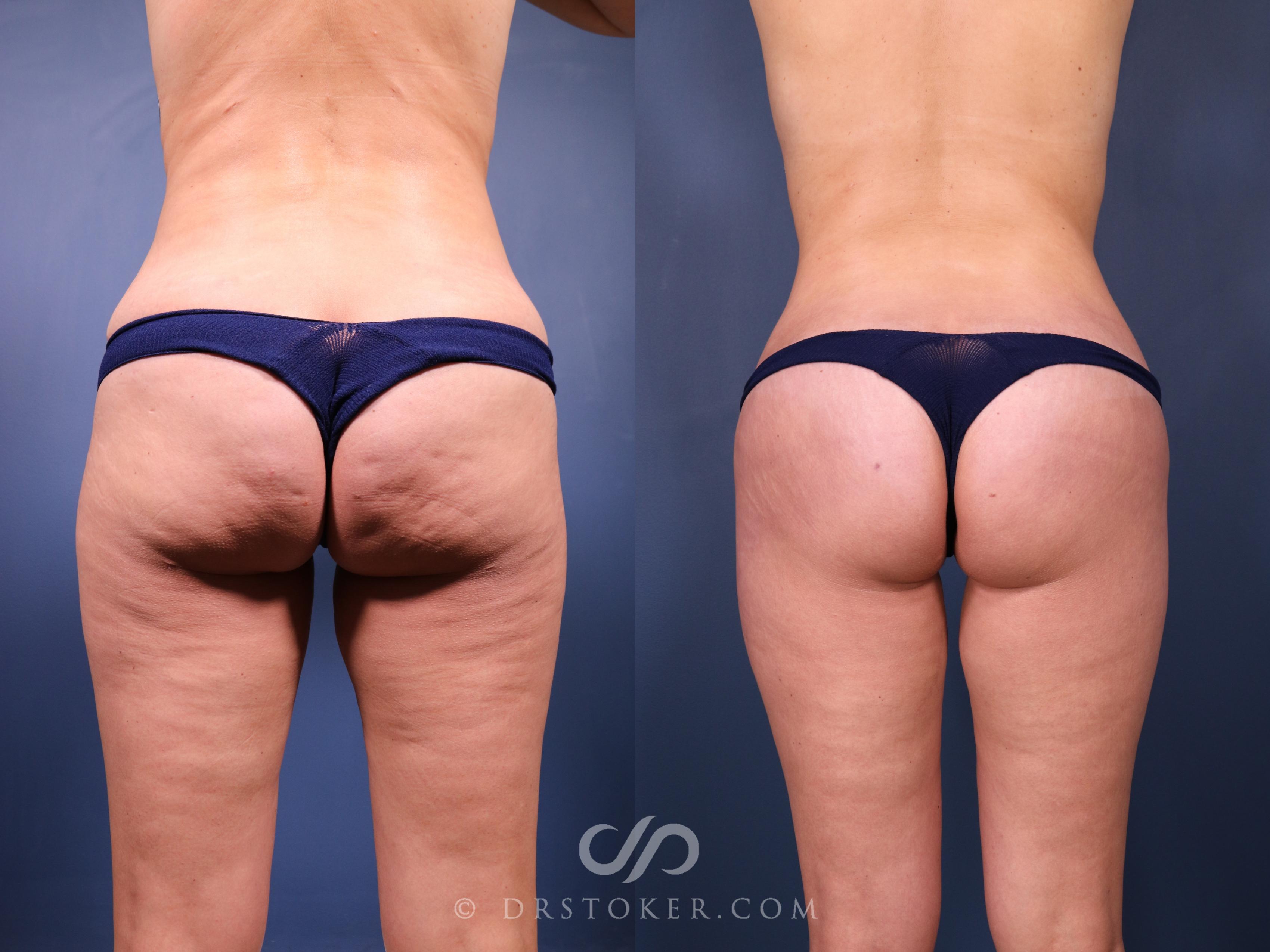 Before & After Bikini Body Lift ™ Case 2463 Back View in Los Angeles, CA
