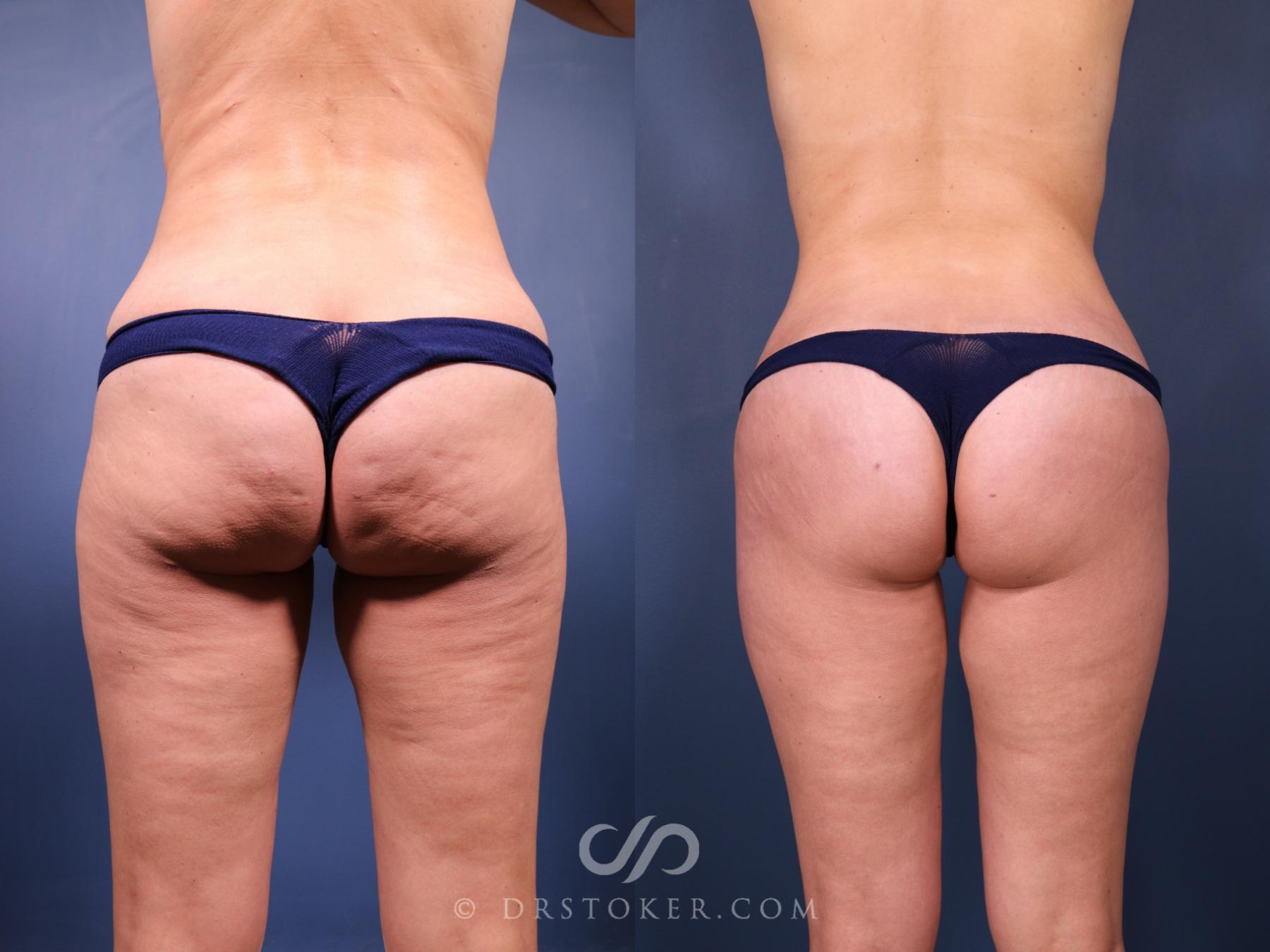 Before & After Bikini Body Lift ™ Case 2463 Back View in Los Angeles, CA