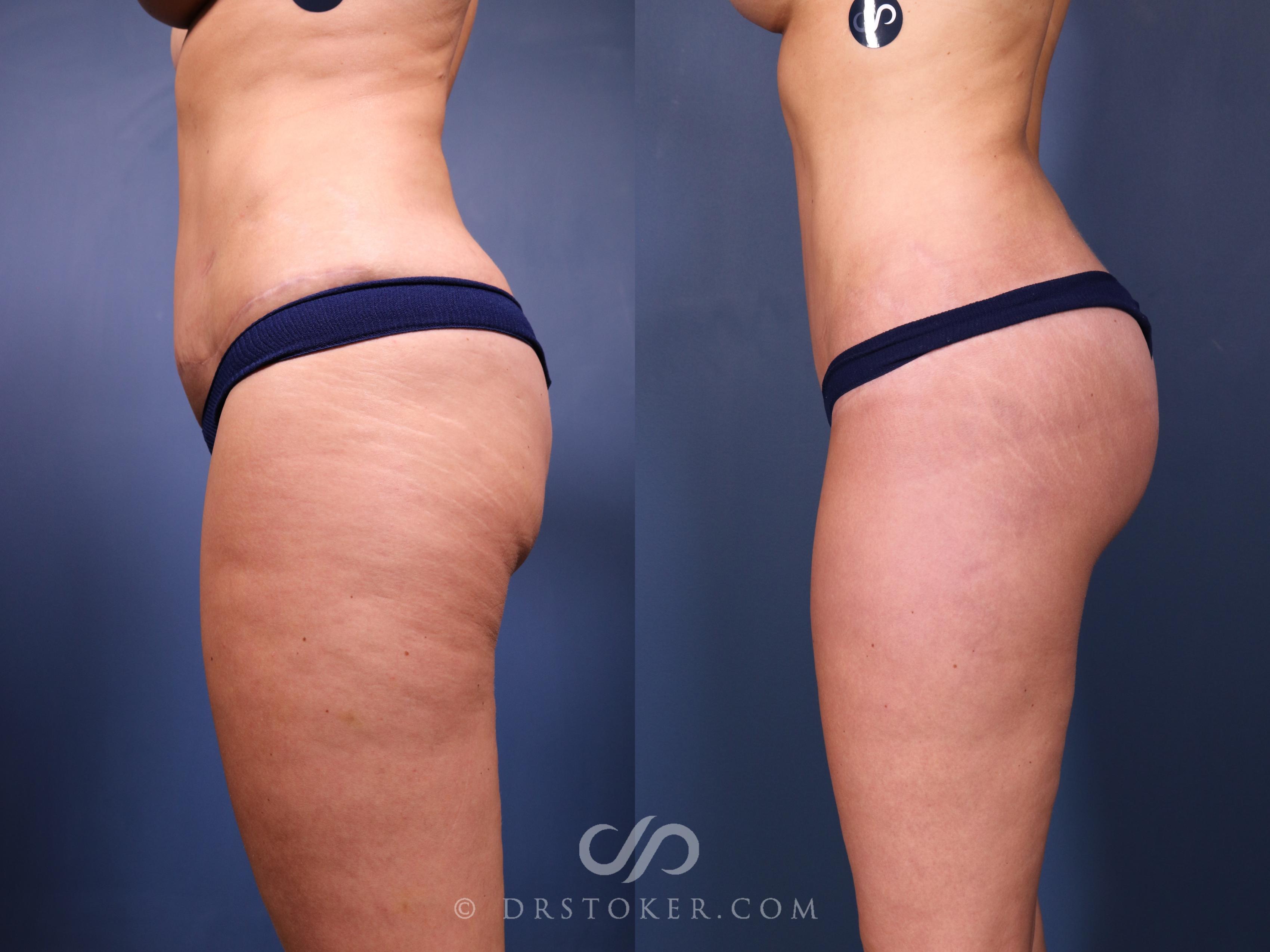 Before & After Bikini Body Lift ™ Case 2463 Left Side View in Los Angeles, CA