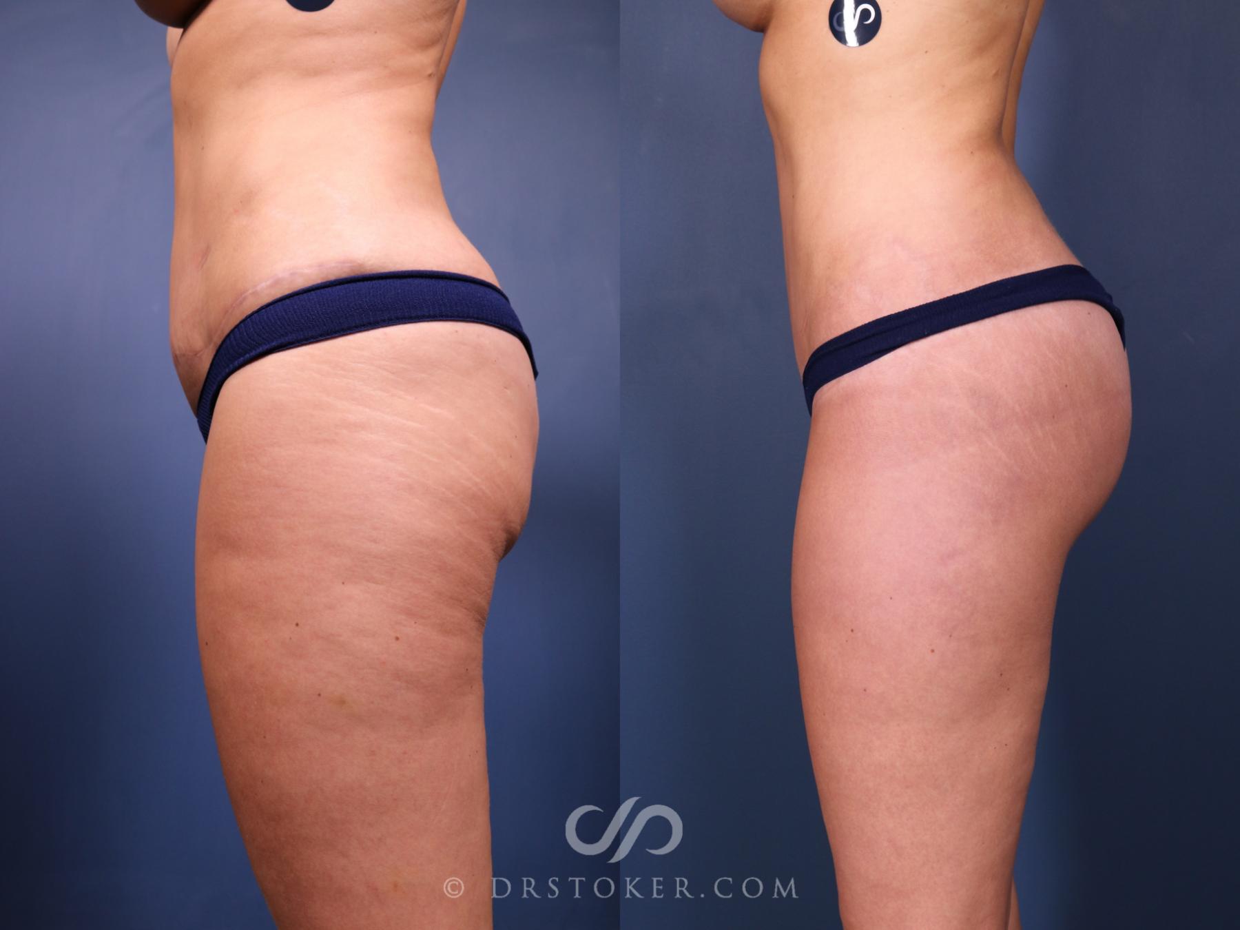Before & After Bikini Body Lift ™ Case 2463 Left Side View in Los Angeles, CA
