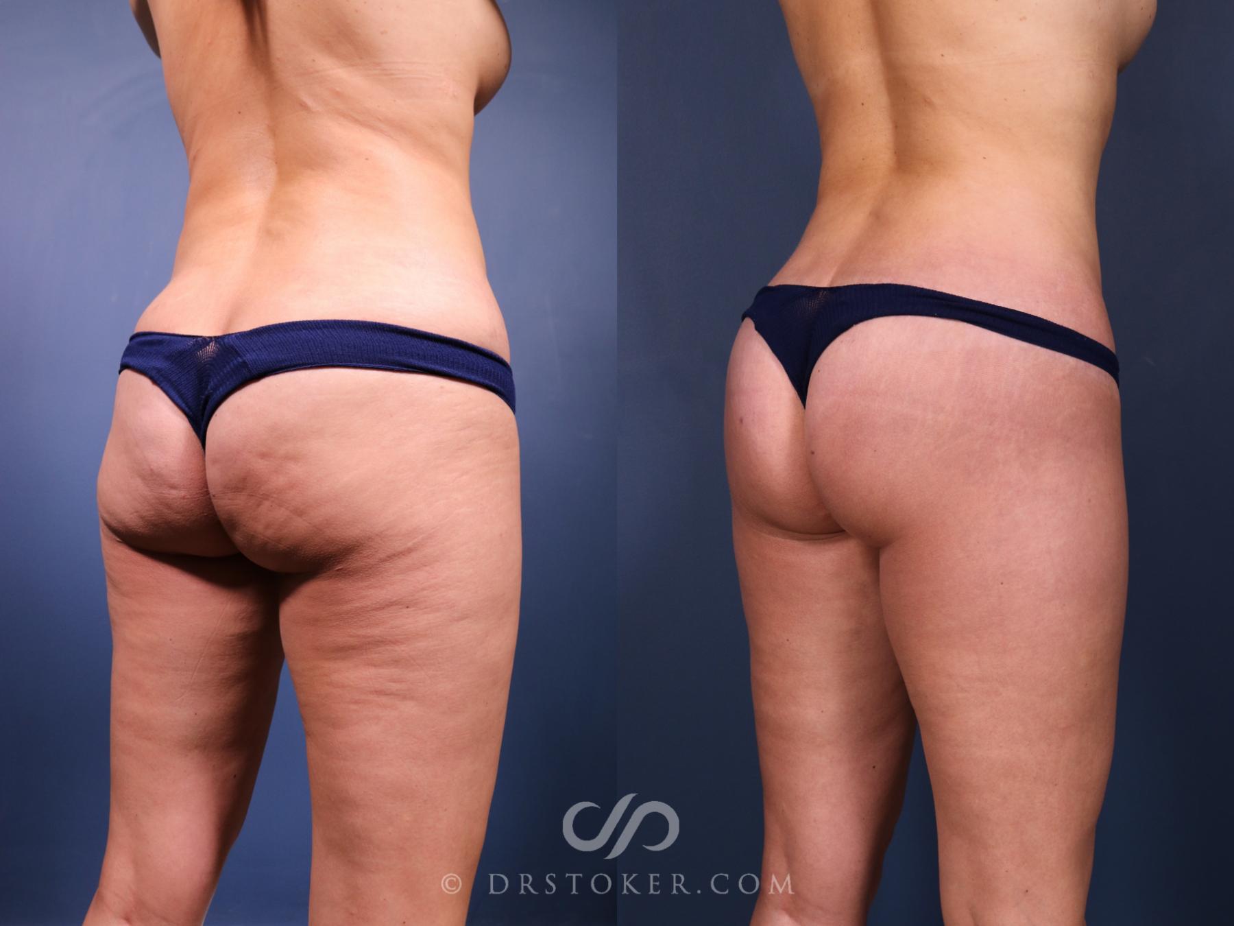 Before & After Bikini Body Lift ™ Case 2463 Right Oblique View in Los Angeles, CA