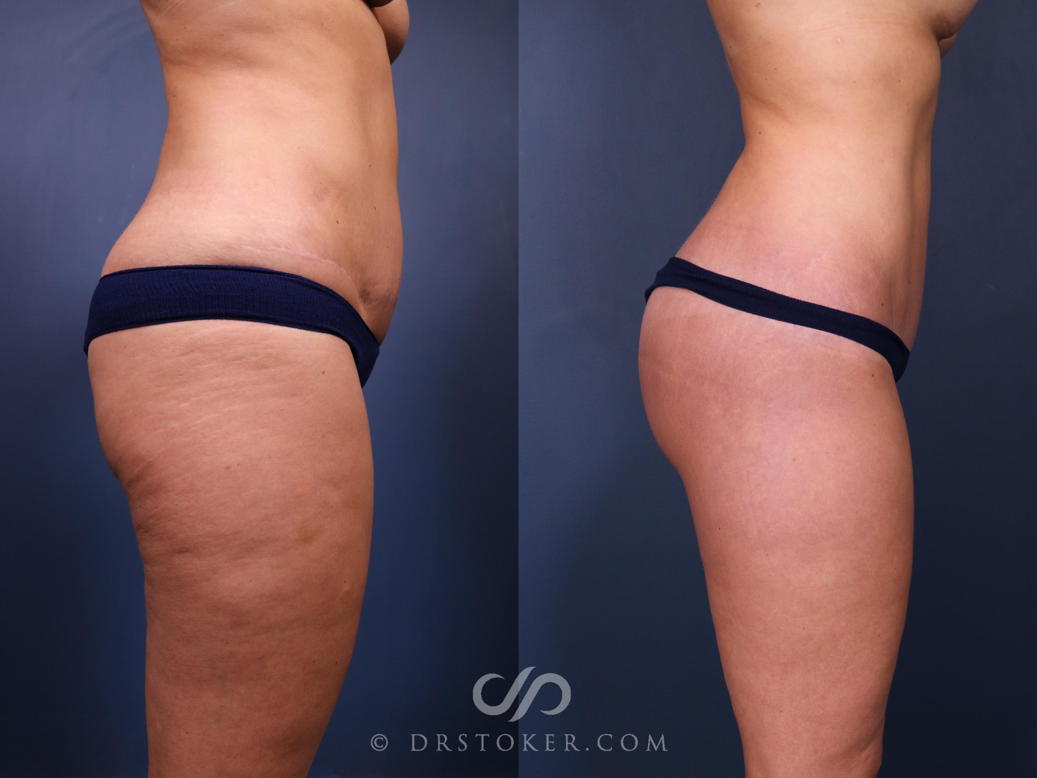 Before & After Bikini Body Lift ™ Case 2463 Right Side View in Los Angeles, CA