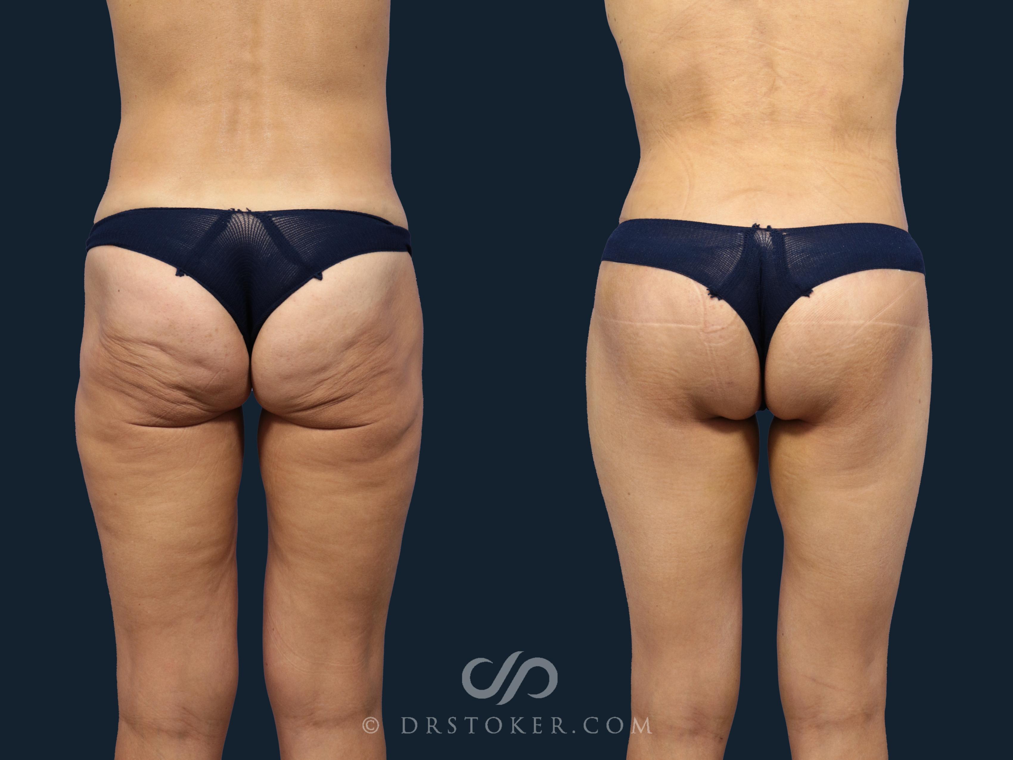 Before & After Bikini Body Lift ™ Case 2466 Back View in Los Angeles, CA