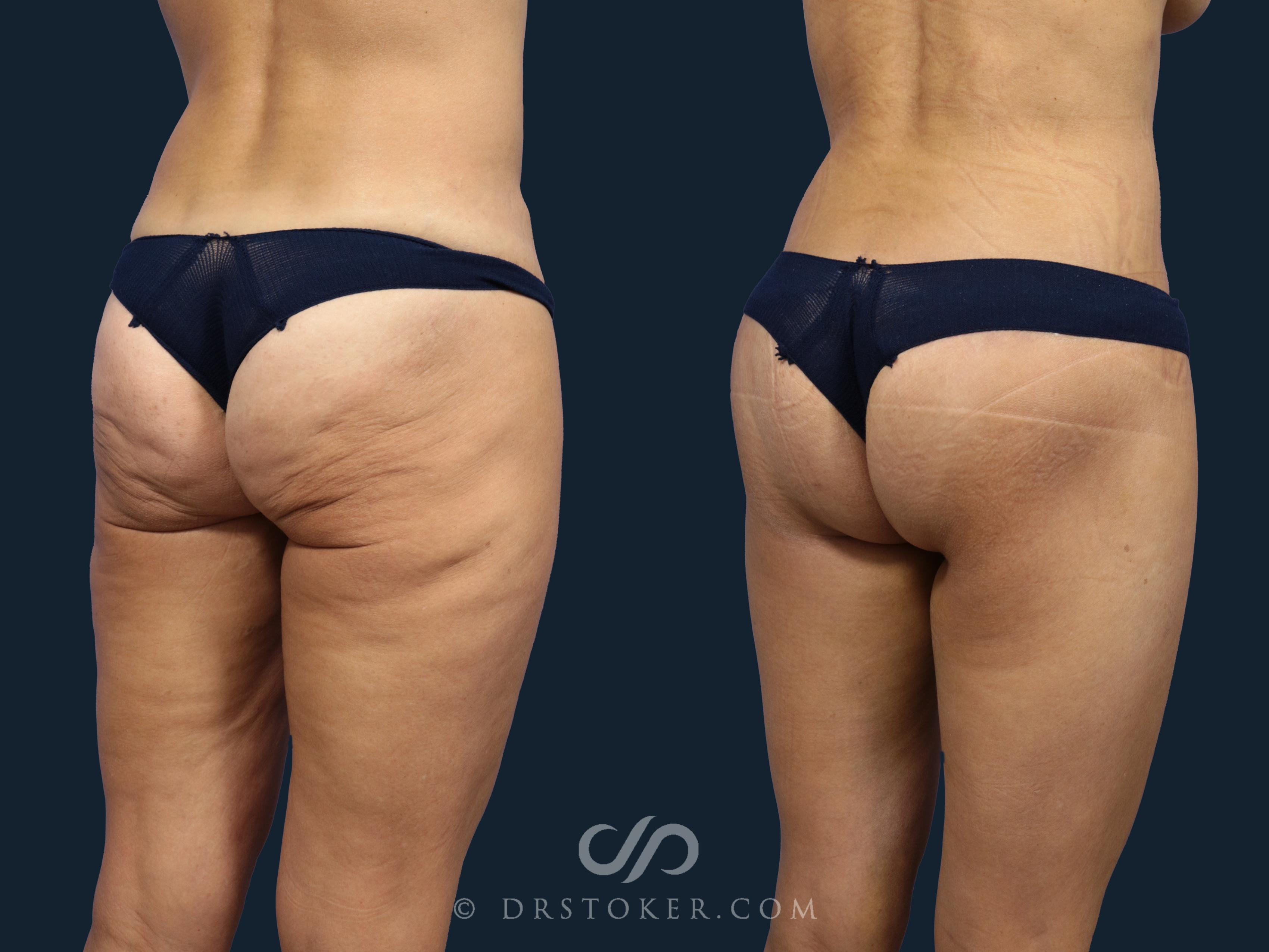 Before & After Bikini Body Lift ™ Case 2466 Right Oblique View in Los Angeles, CA