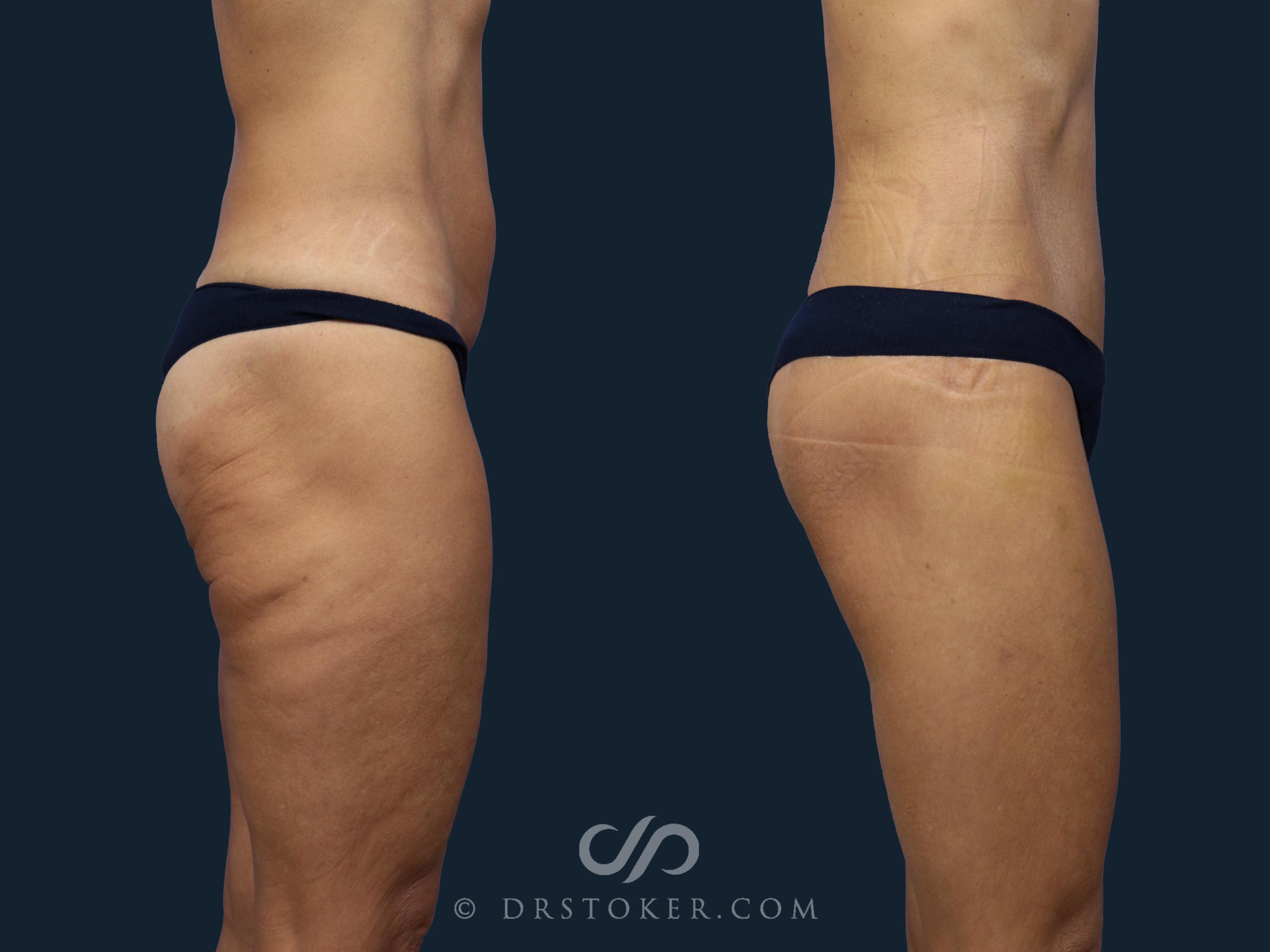 Before & After Bikini Body Lift ™ Case 2466 Right Side View in Los Angeles, CA
