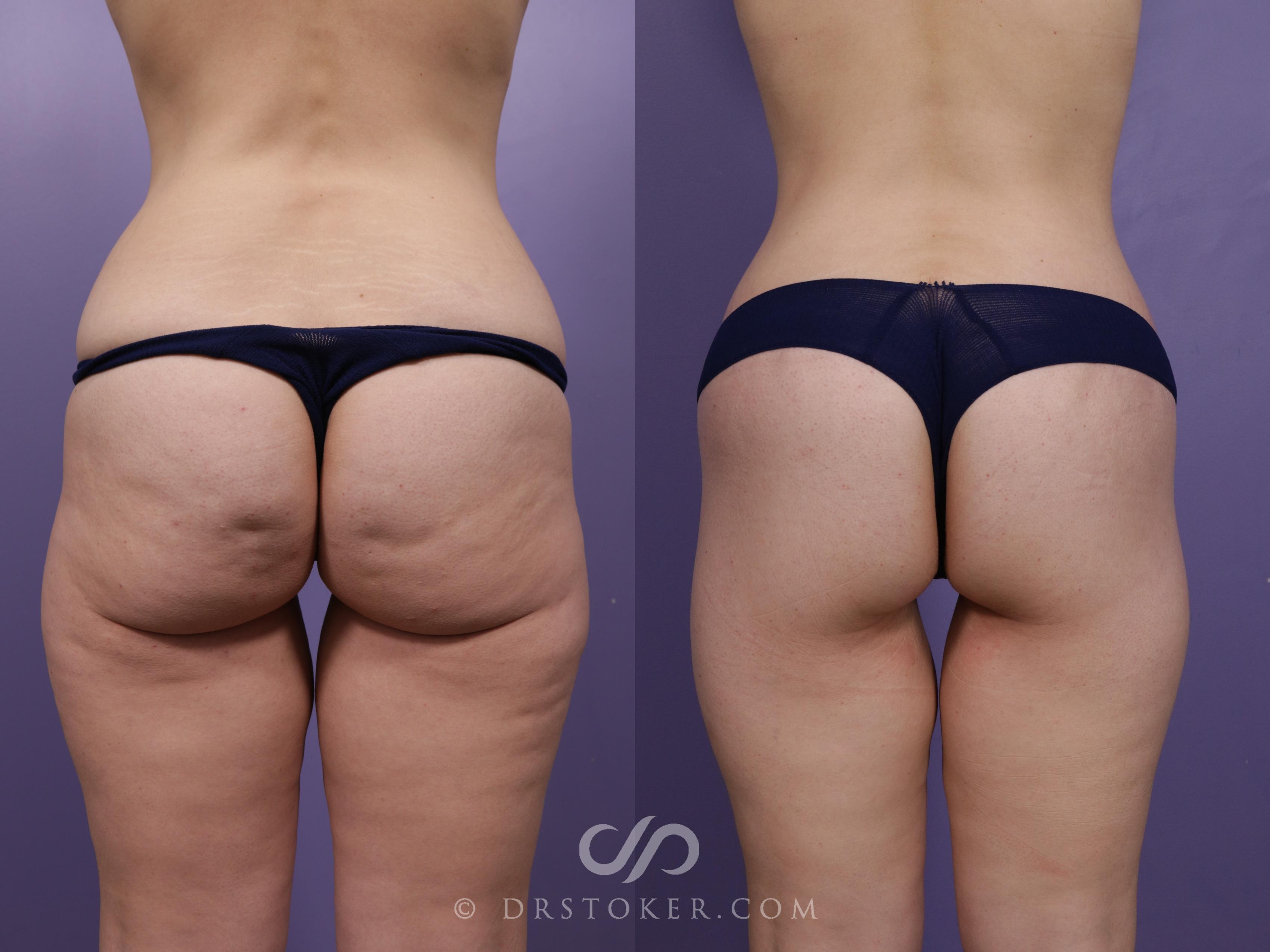 Before & After Bikini Body Lift ™ Case 2467 Back View in Los Angeles, CA