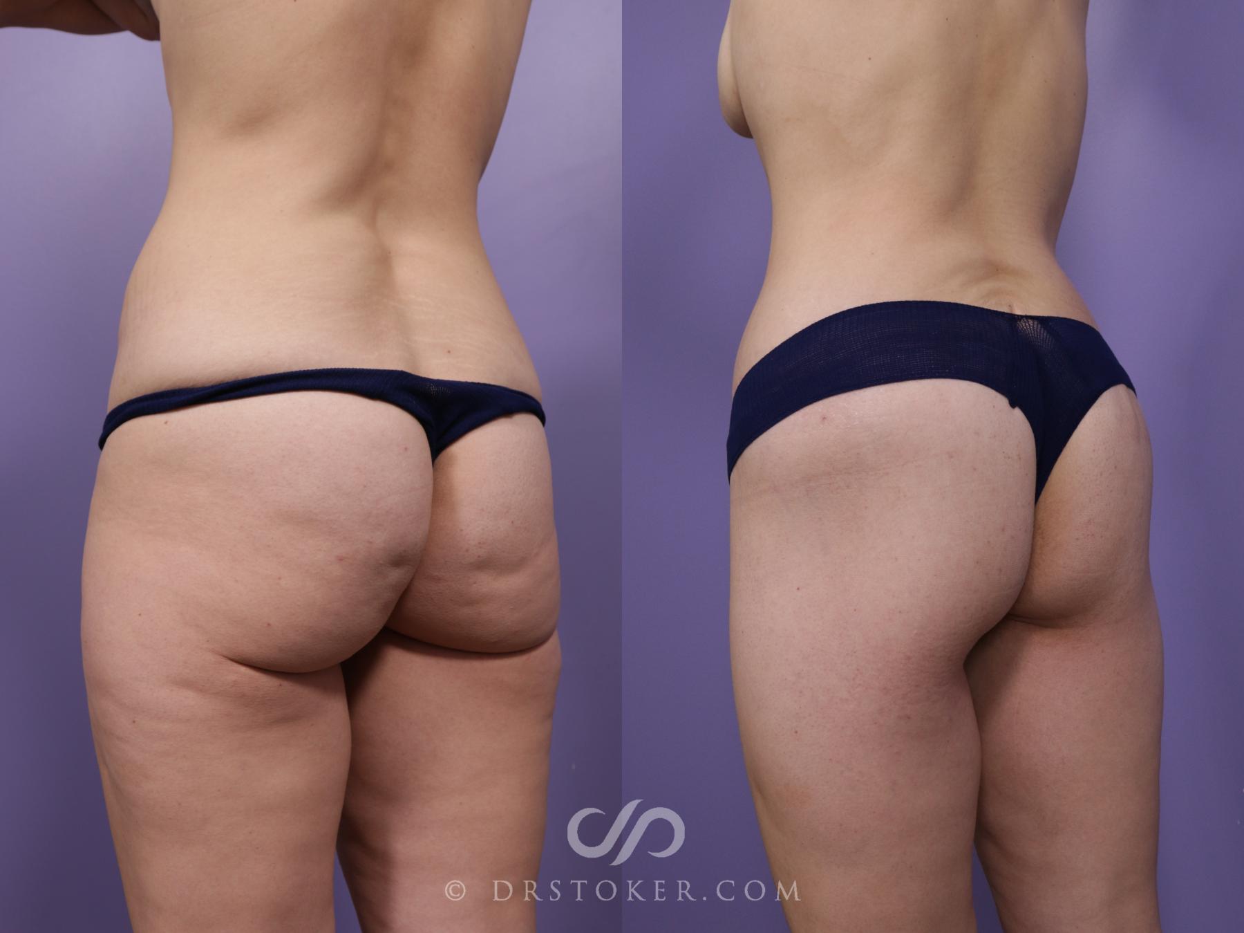 Before & After Bikini Body Lift ™ Case 2467 Left Oblique View in Los Angeles, CA