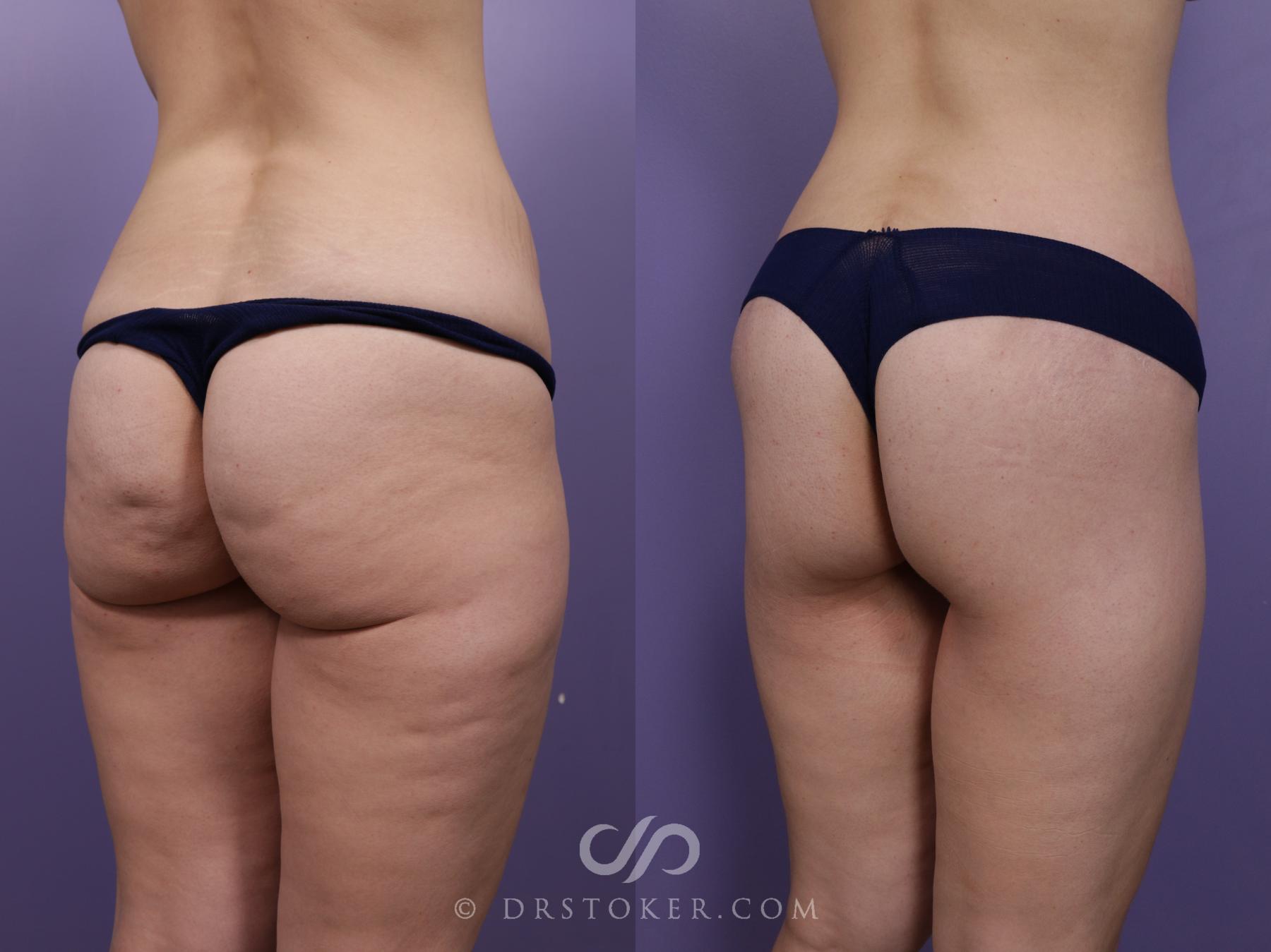 Before & After Bikini Body Lift ™ Case 2467 Right Oblique View in Los Angeles, CA