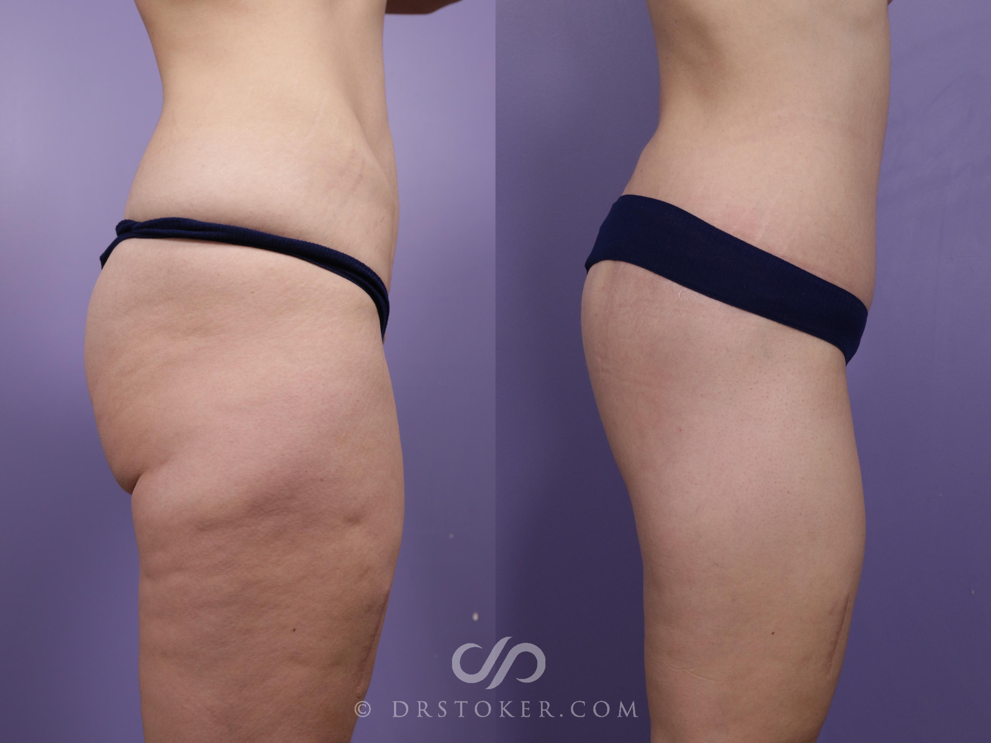 Before & After Bikini Body Lift ™ Case 2467 Right Side View in Los Angeles, CA