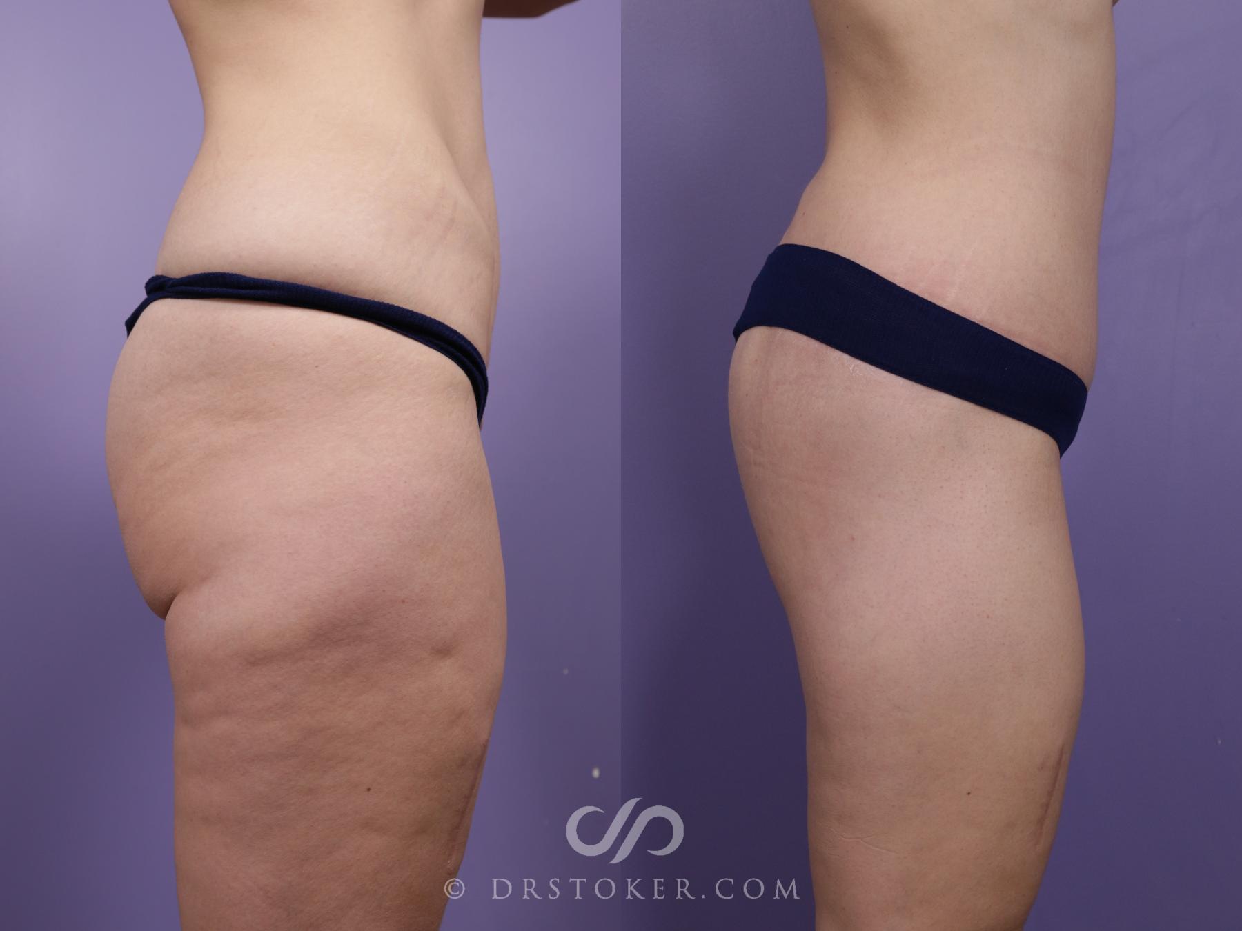 Before & After Bikini Body Lift ™ Case 2467 Right Side View in Los Angeles, CA