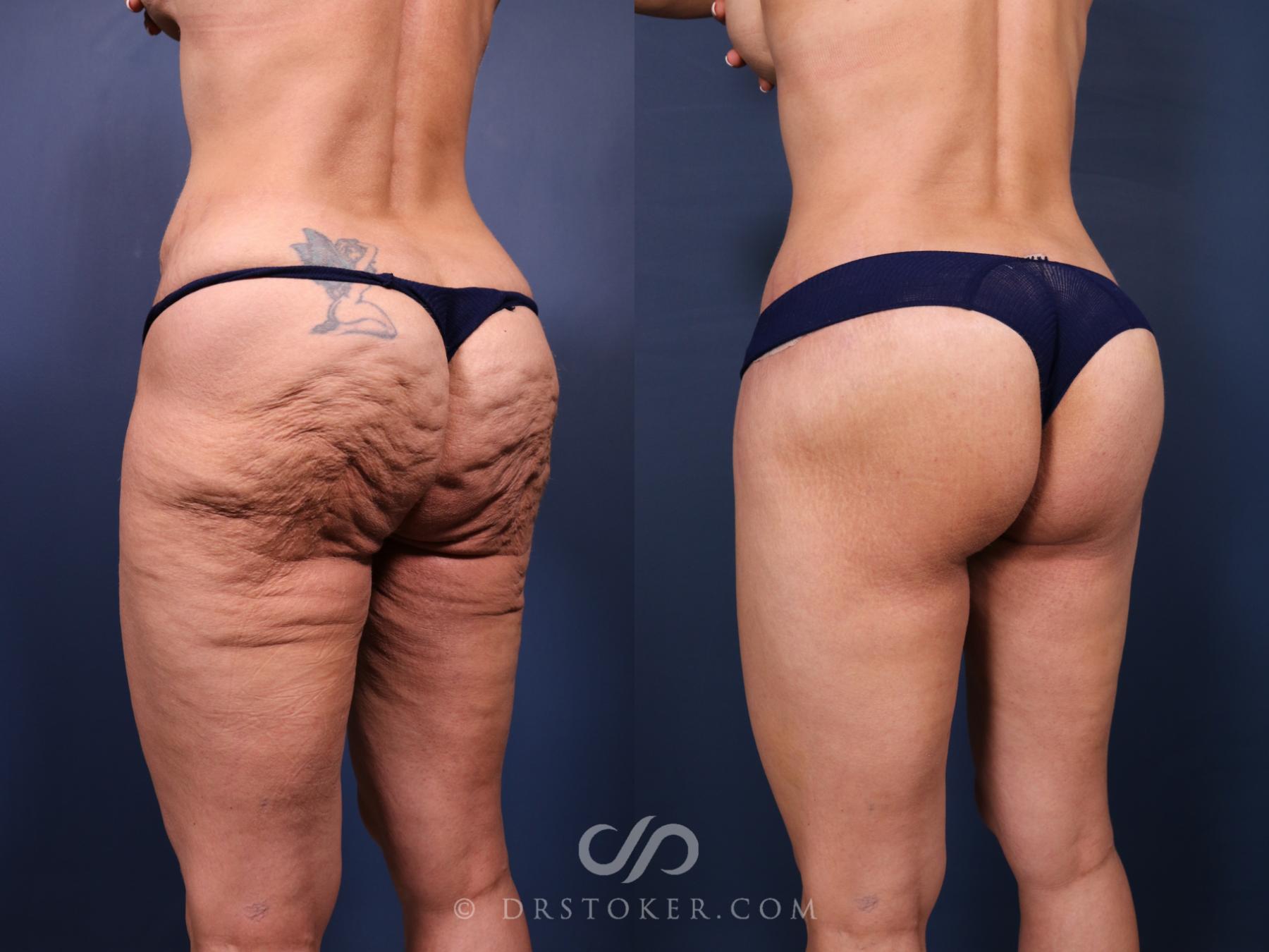Before & After Bikini Body Lift ™ Case 2474 Left Oblique View in Los Angeles, CA