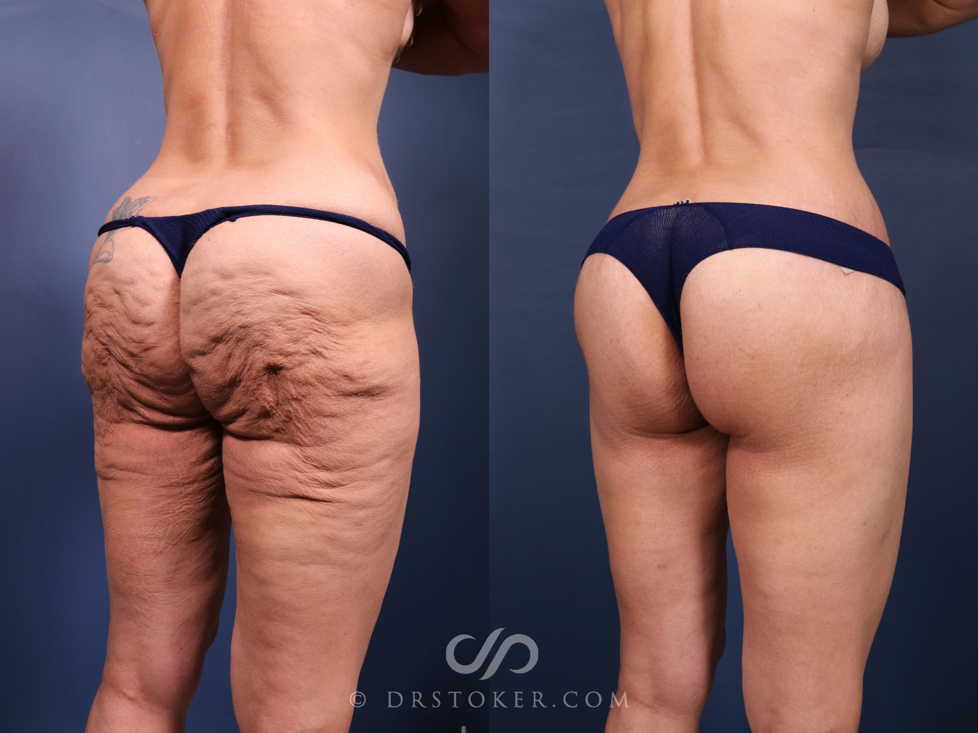 Before & After Bikini Body Lift ™ Case 2474 Right Oblique View in Los Angeles, CA
