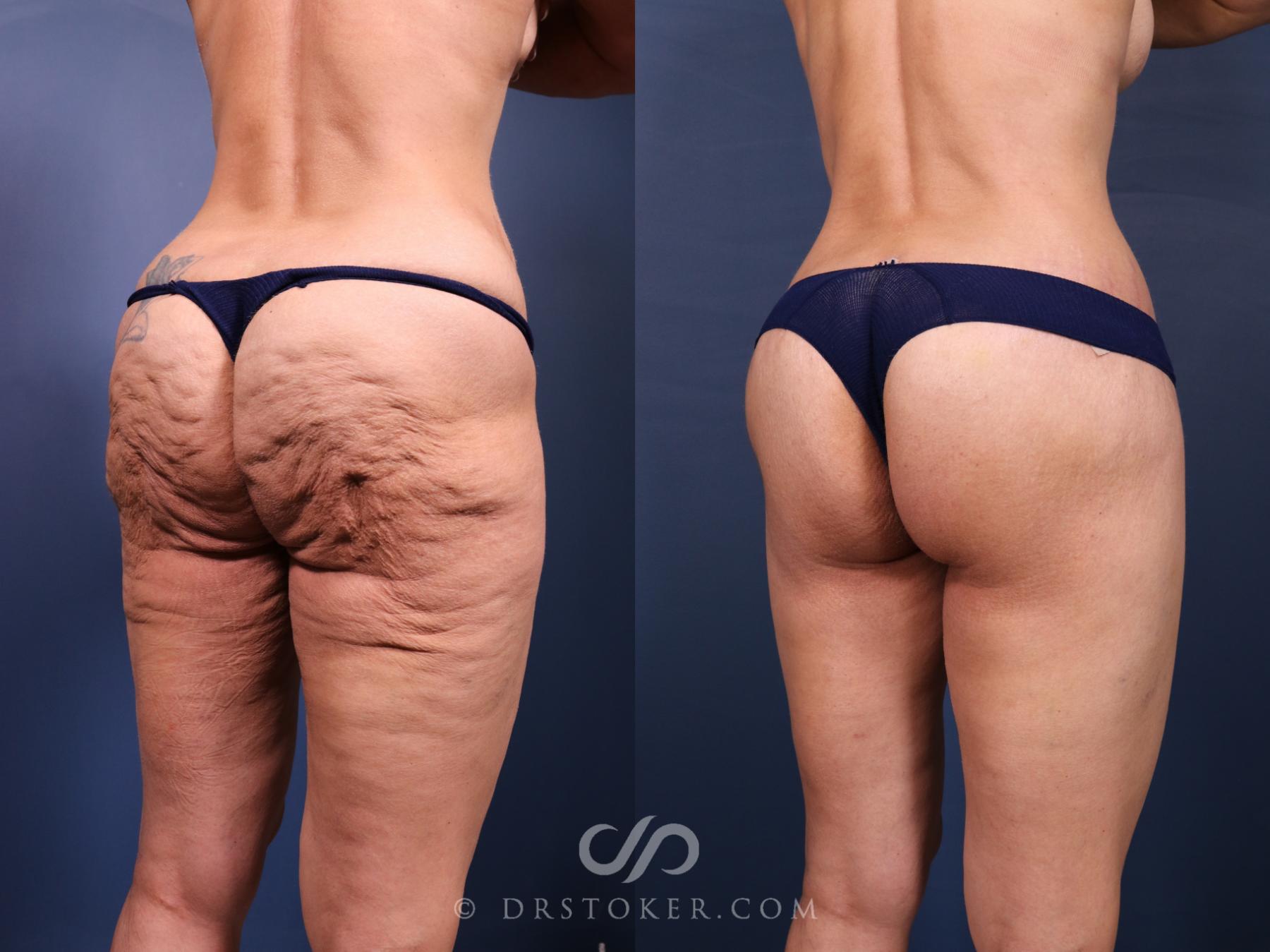 Before & After Bikini Body Lift ™ Case 2474 Right Oblique View in Los Angeles, CA