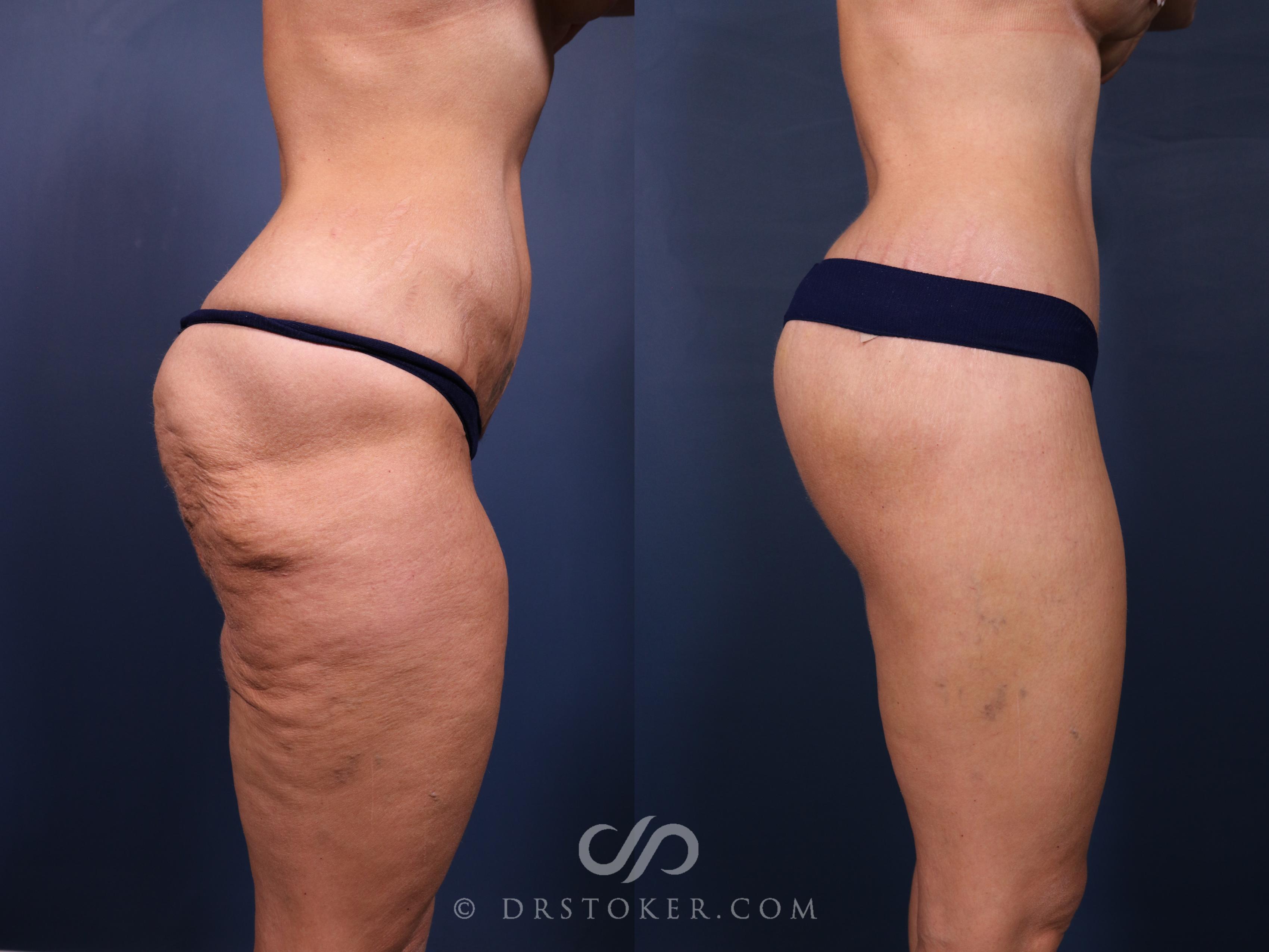 Before & After Bikini Body Lift ™ Case 2474 Right Side View in Los Angeles, CA
