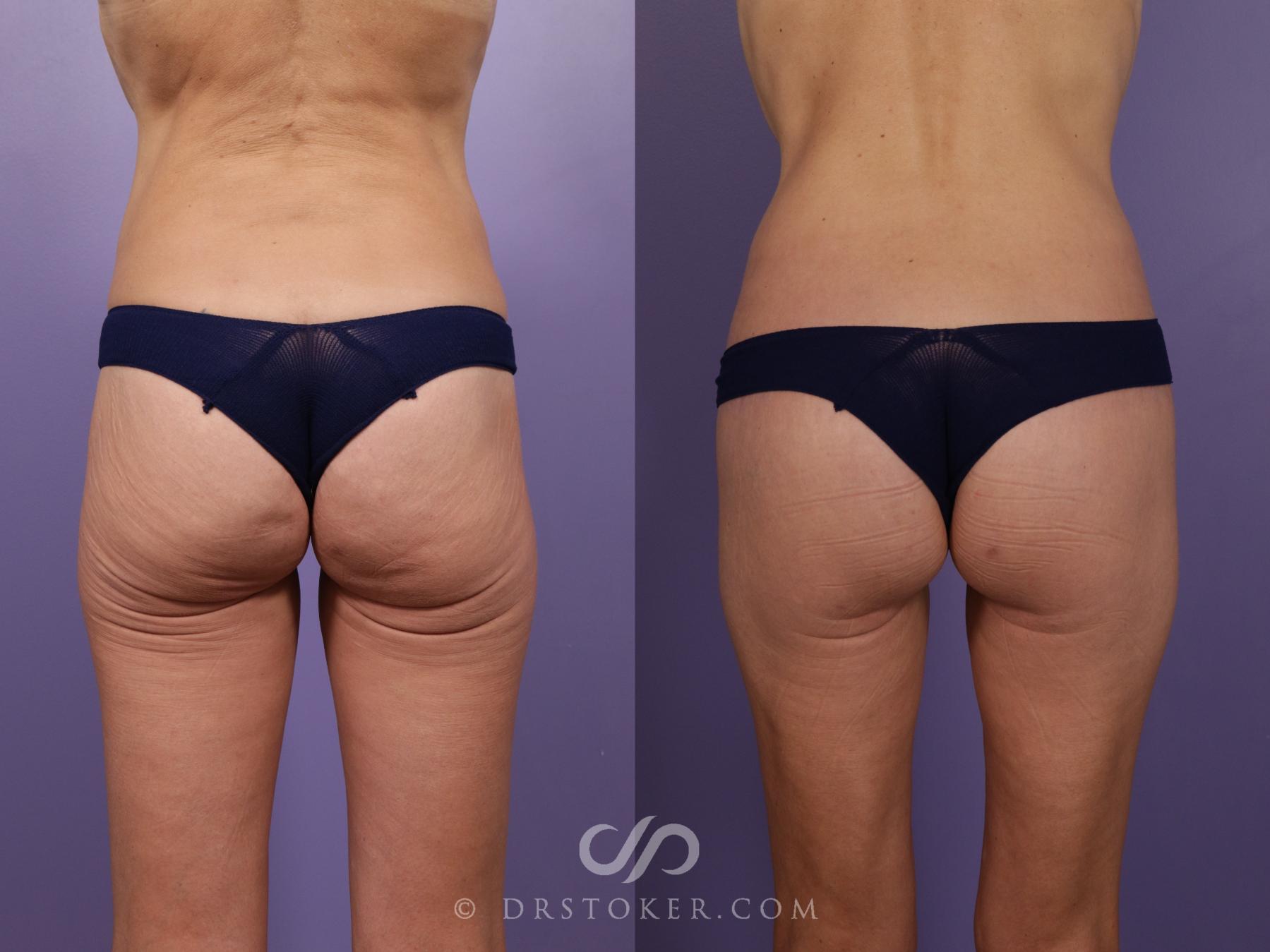 Before & After Bikini Body Lift ™ Case 2475 Back View in Los Angeles, CA