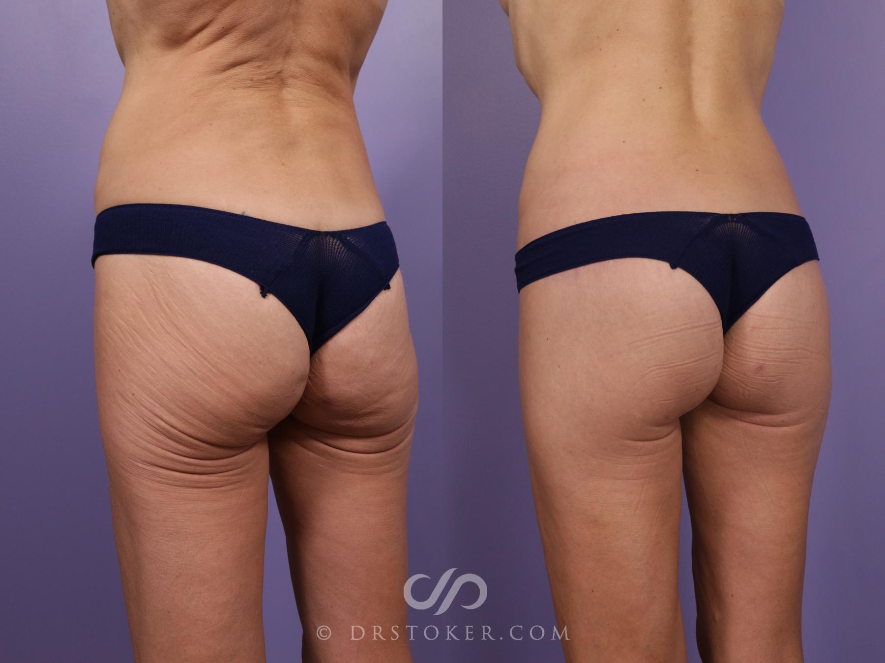Before & After Bikini Body Lift ™ Case 2475 Left Oblique View in Los Angeles, CA