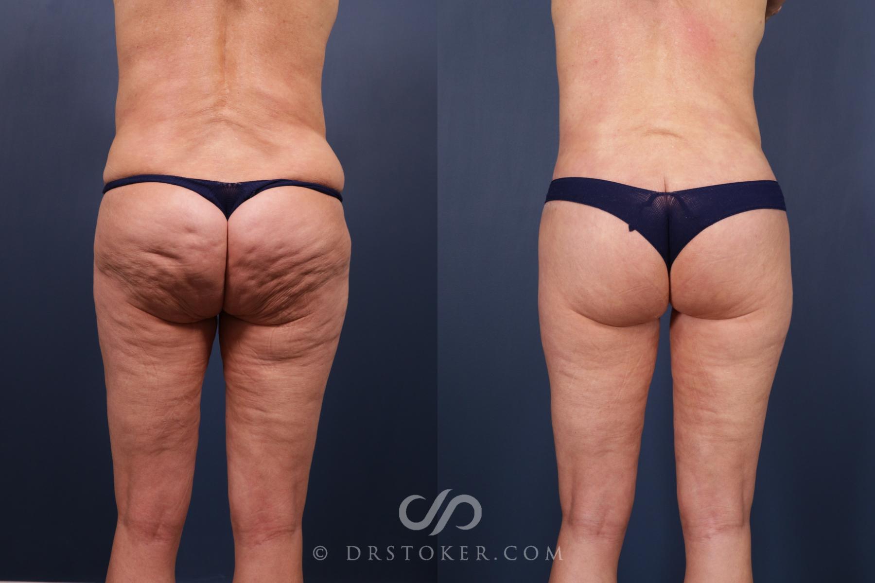 Before & After Bikini Body Lift ™ Case 2476 Back View in Los Angeles, CA