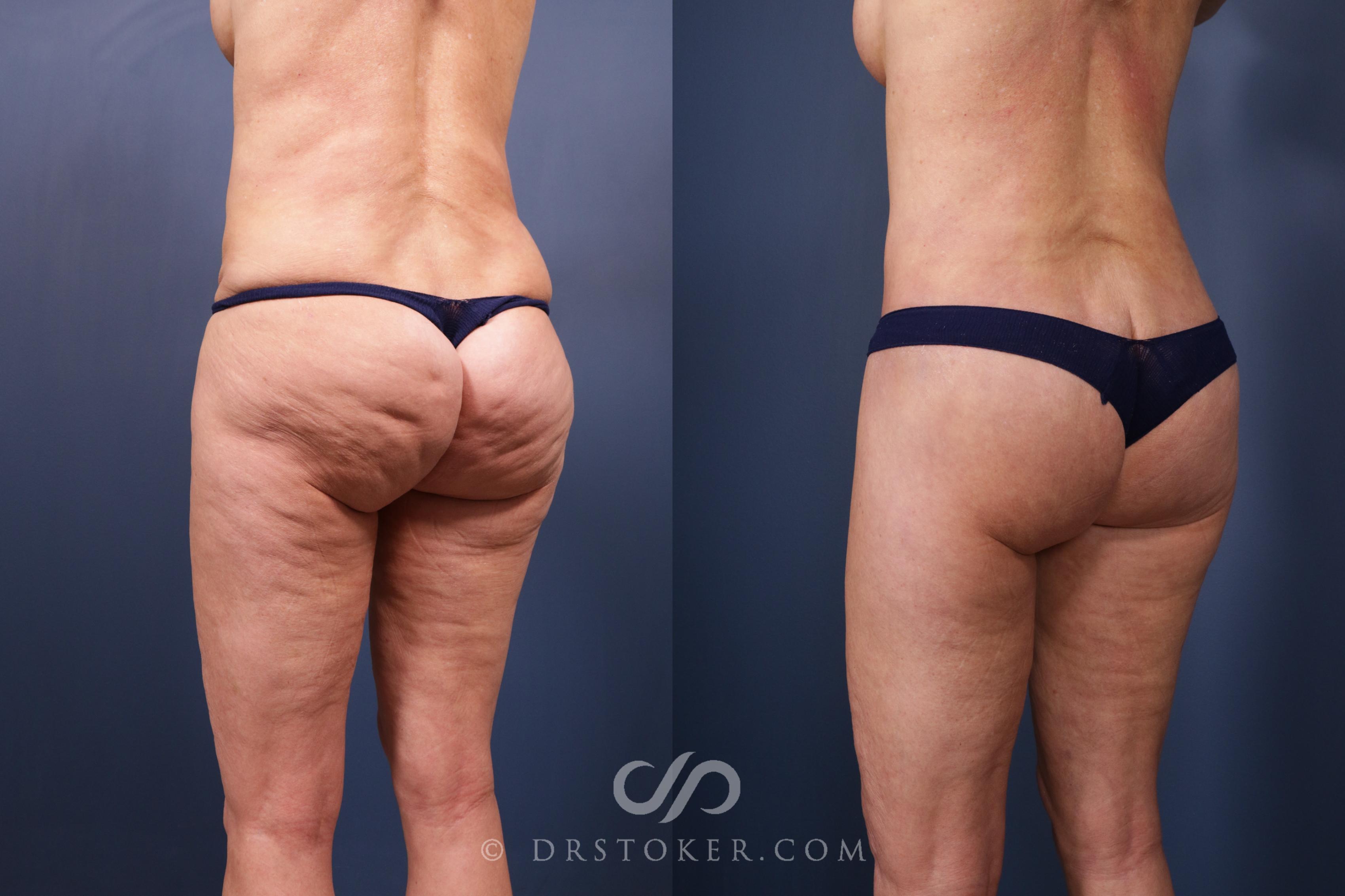 Before & After Bikini Body Lift ™ Case 2476 Left Oblique View in Los Angeles, CA
