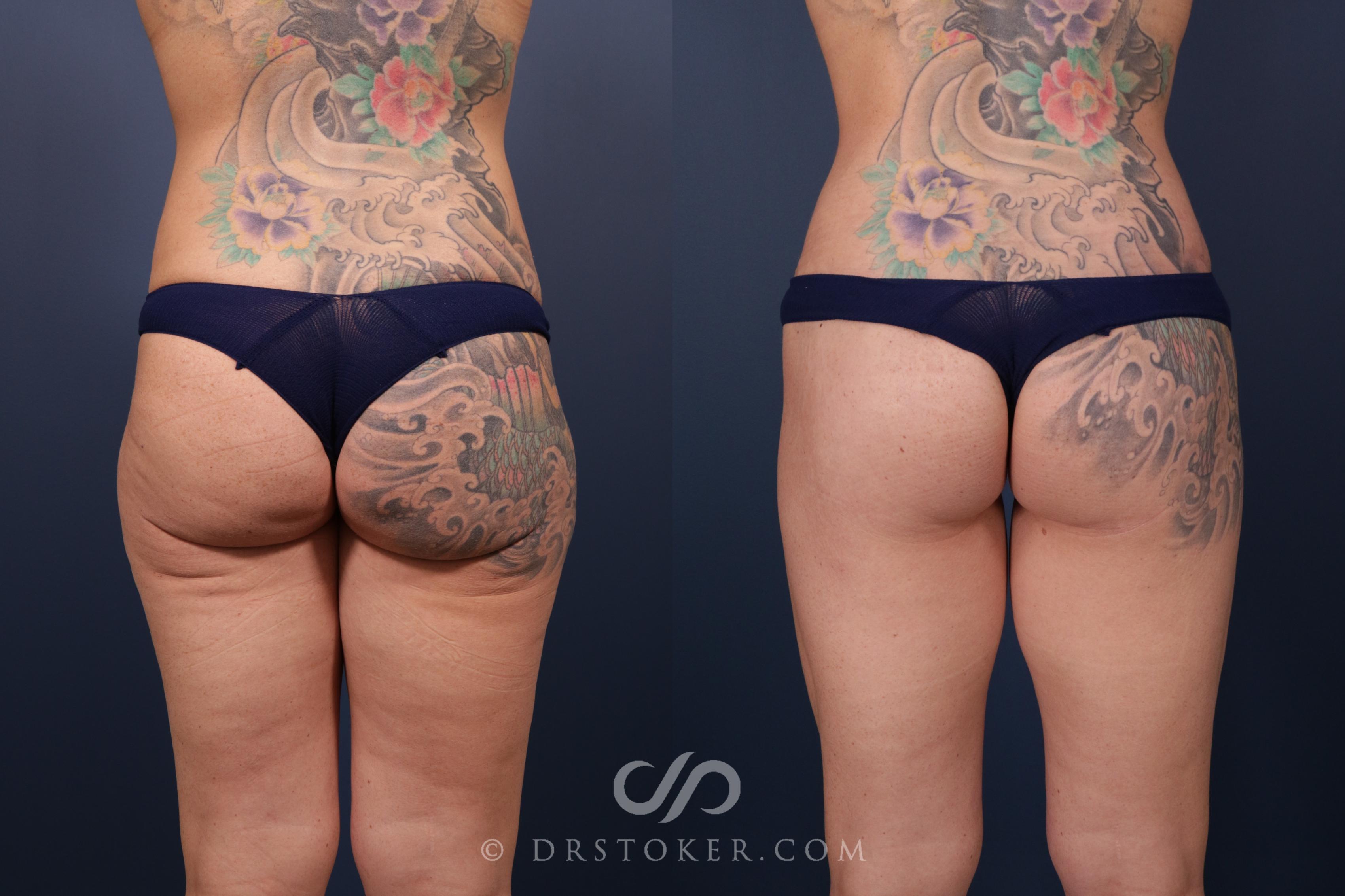 Before & After Bikini Body Lift ™ Case 2477 Back View in Los Angeles, CA