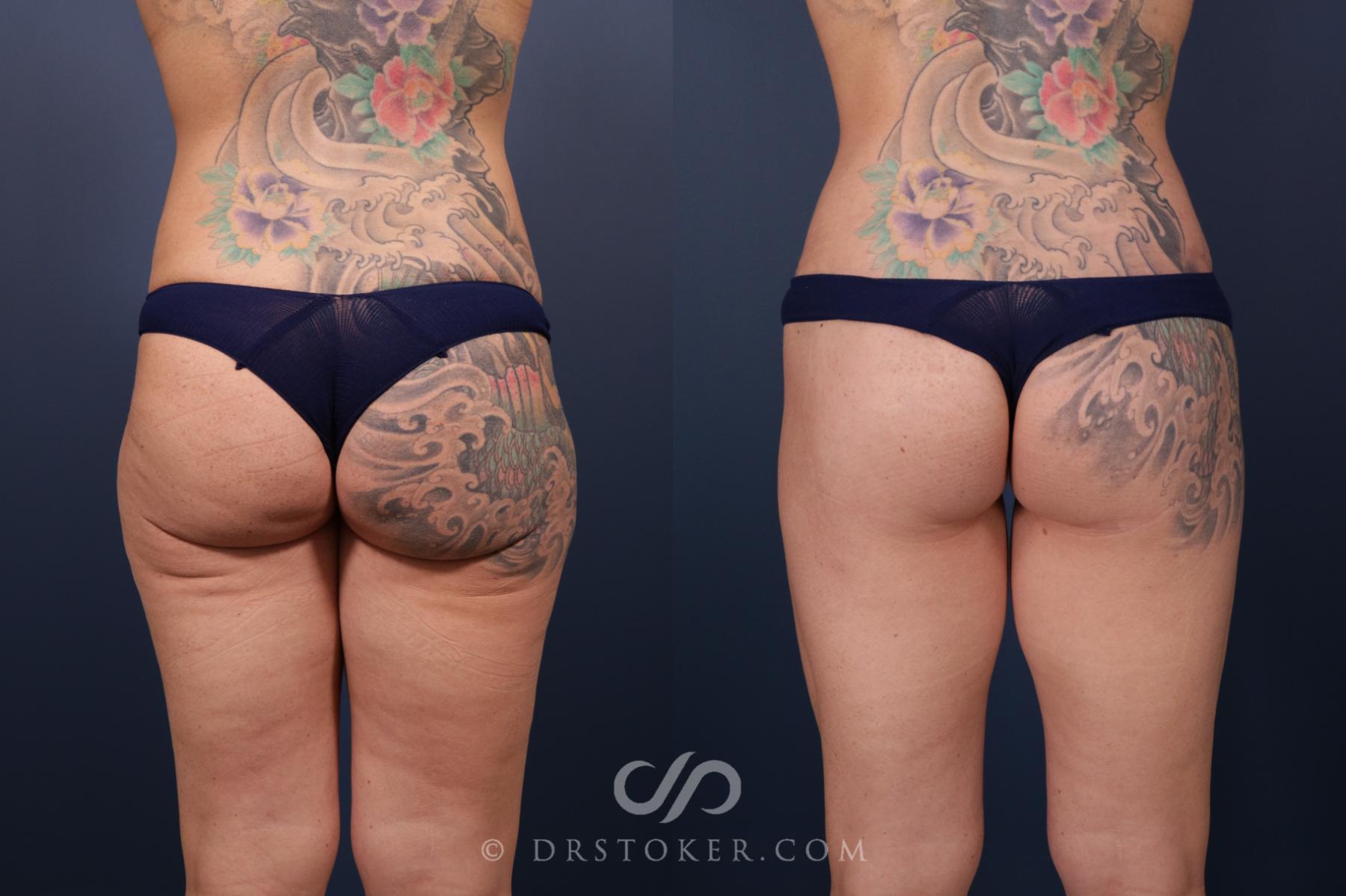 Before & After Bikini Body Lift ™ Case 2477 Back View in Los Angeles, CA
