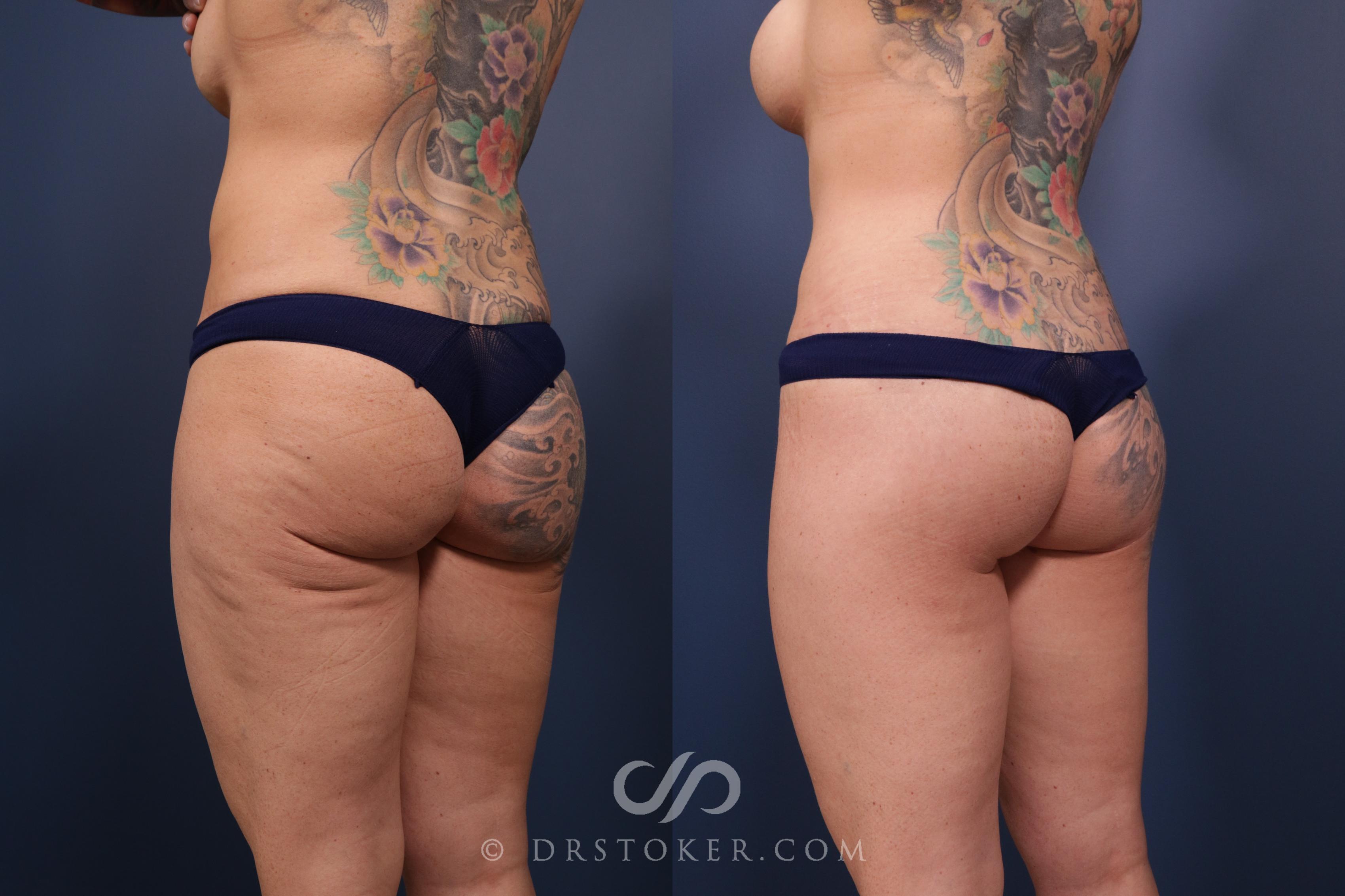 Before & After Bikini Body Lift ™ Case 2477 Left Oblique View in Los Angeles, CA