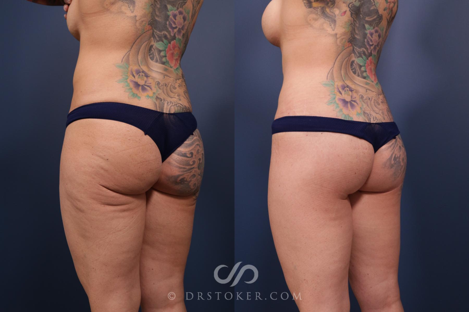 Before & After Bikini Body Lift ™ Case 2477 Left Oblique View in Los Angeles, CA