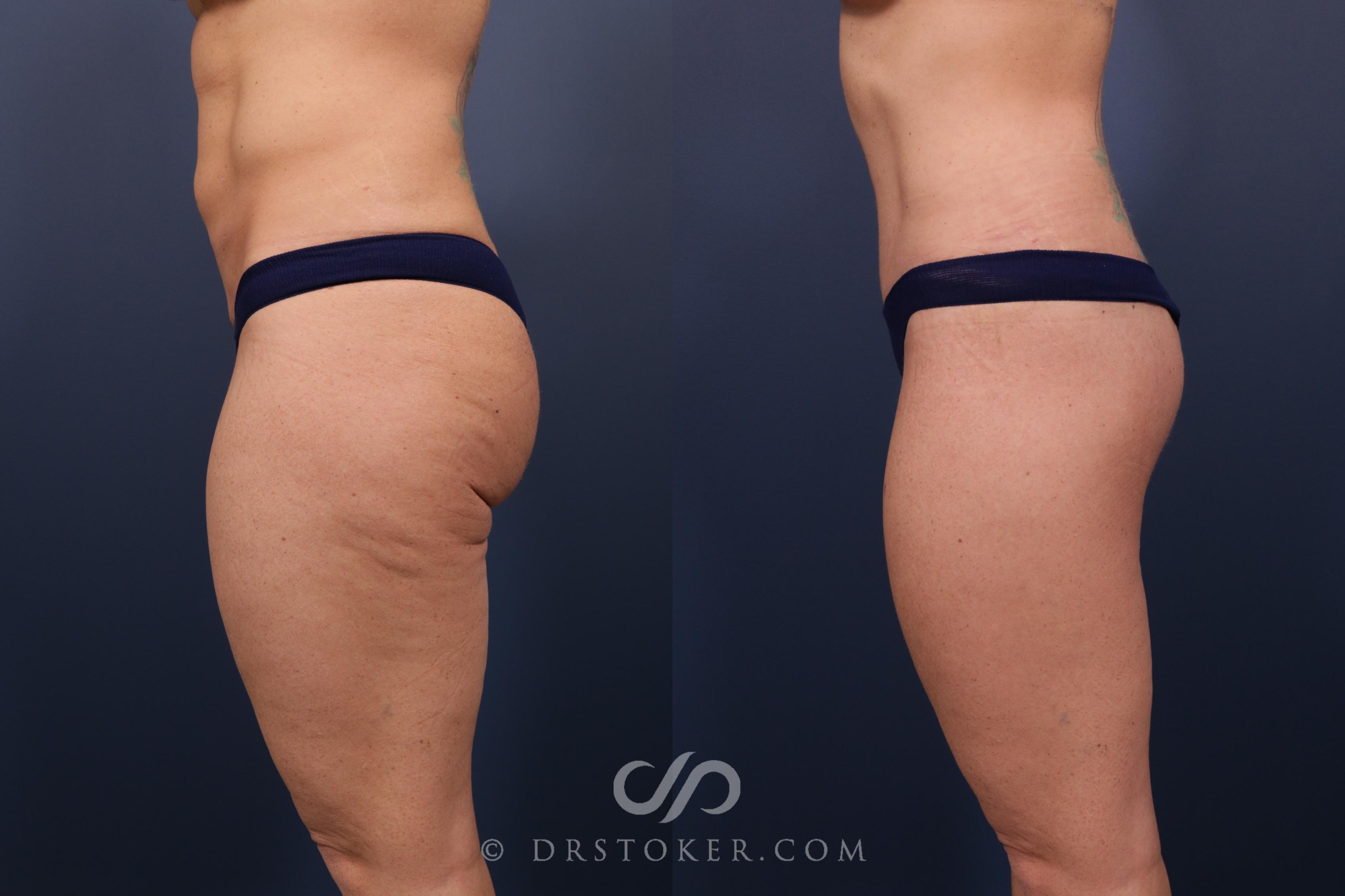 Before & After Bikini Body Lift ™ Case 2477 Left Side View in Los Angeles, CA