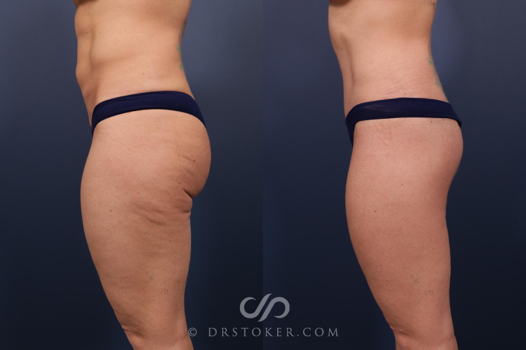 Before & After Bikini Body Lift ™ Case 2477 Left Side View in Los Angeles, CA