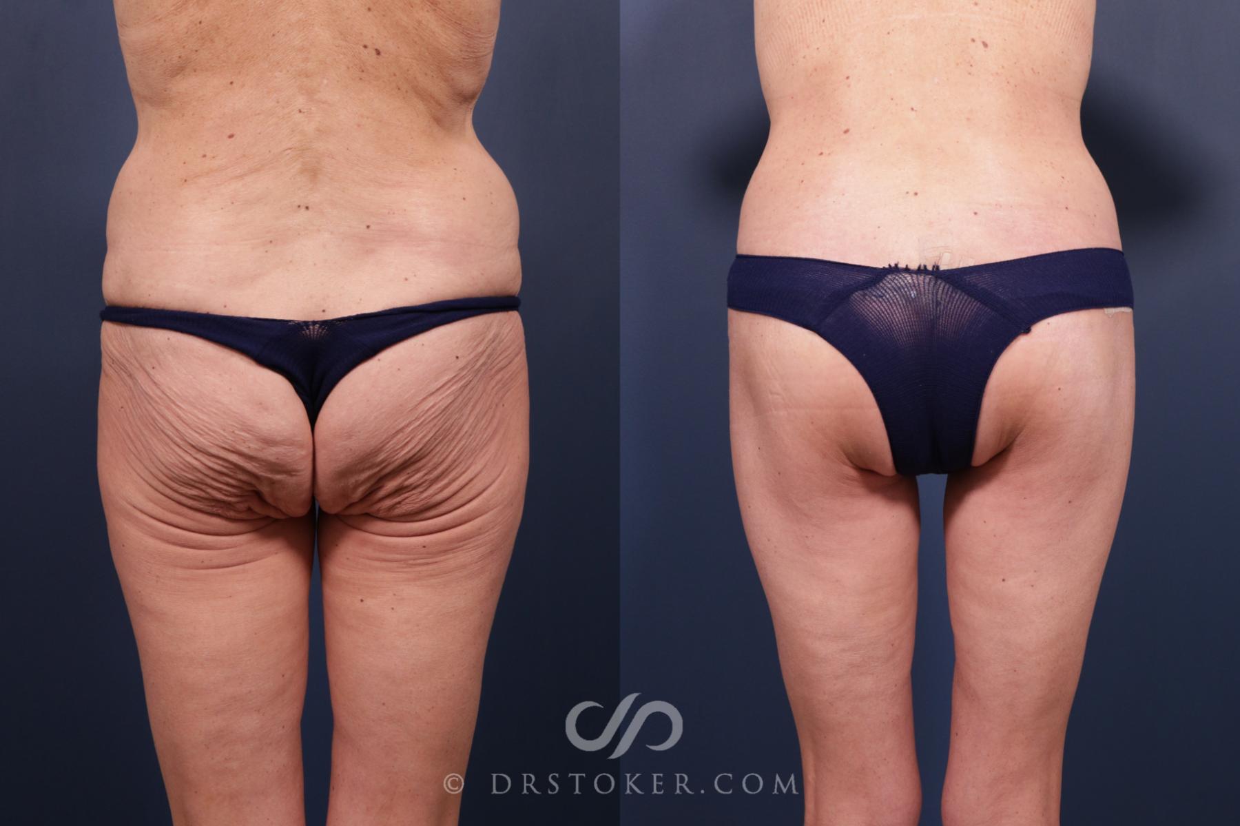 Before & After Bikini Body Lift ™ Case 2478 Back View in Los Angeles, CA