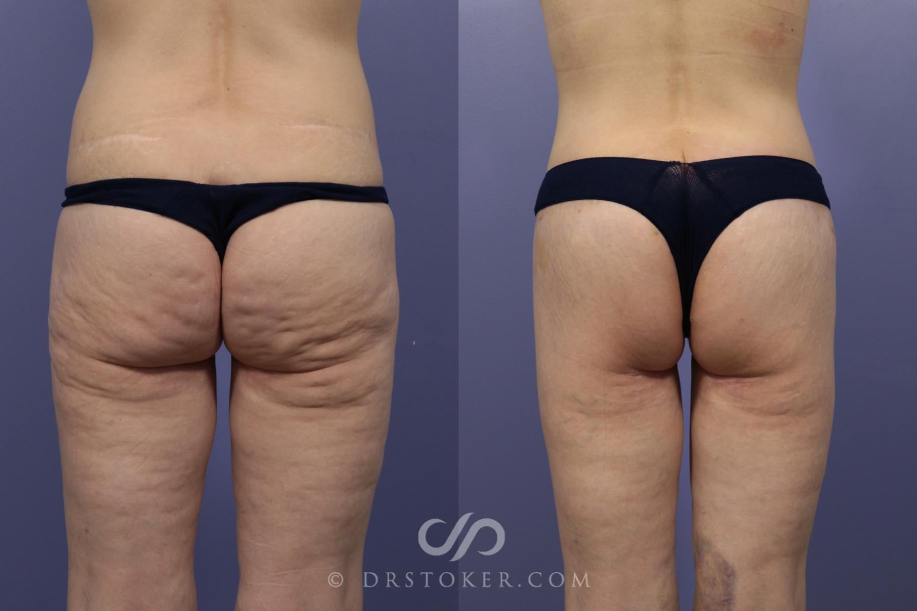 Before & After Bikini Body Lift ™ Case 2480 Back View in Los Angeles, CA