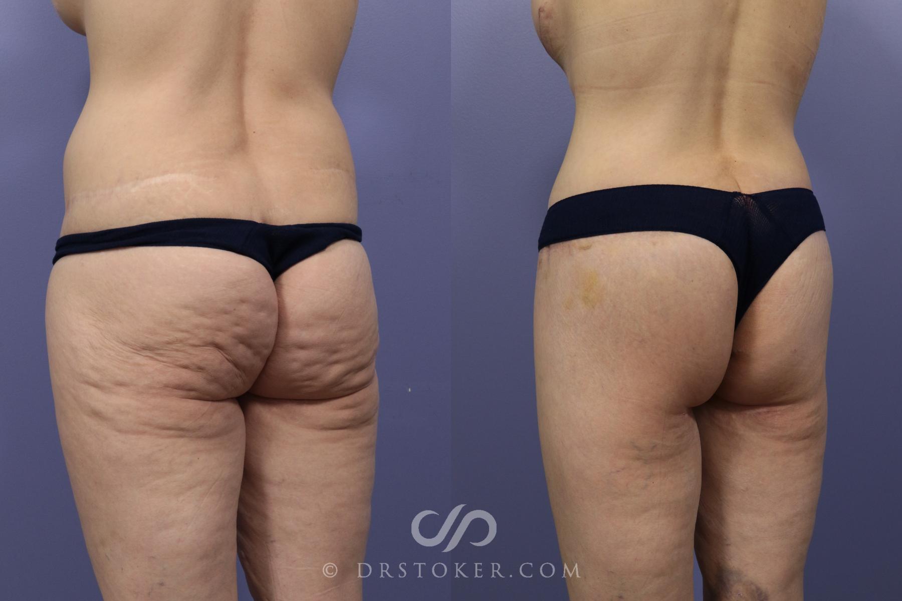 Before & After Bikini Body Lift ™ Case 2480 Left Oblique View in Los Angeles, CA