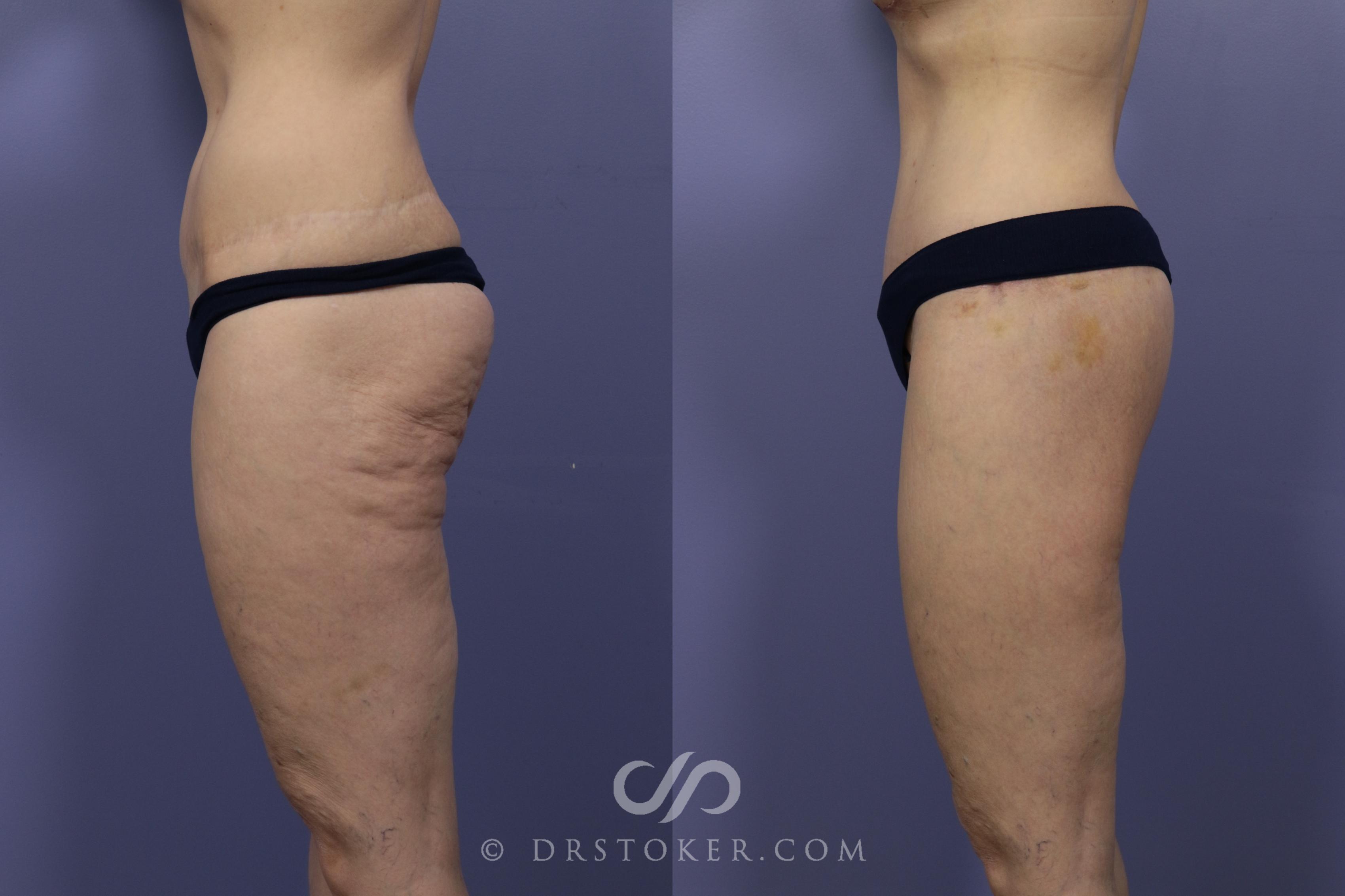 Before & After Bikini Body Lift ™ Case 2480 Left Side View in Los Angeles, CA