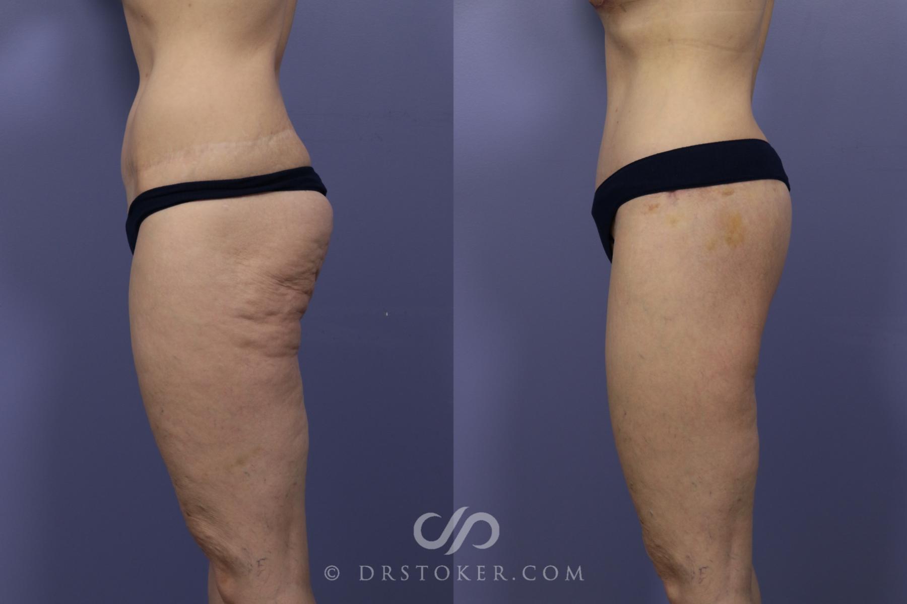 Before & After Bikini Body Lift ™ Case 2480 Left Side View in Los Angeles, CA