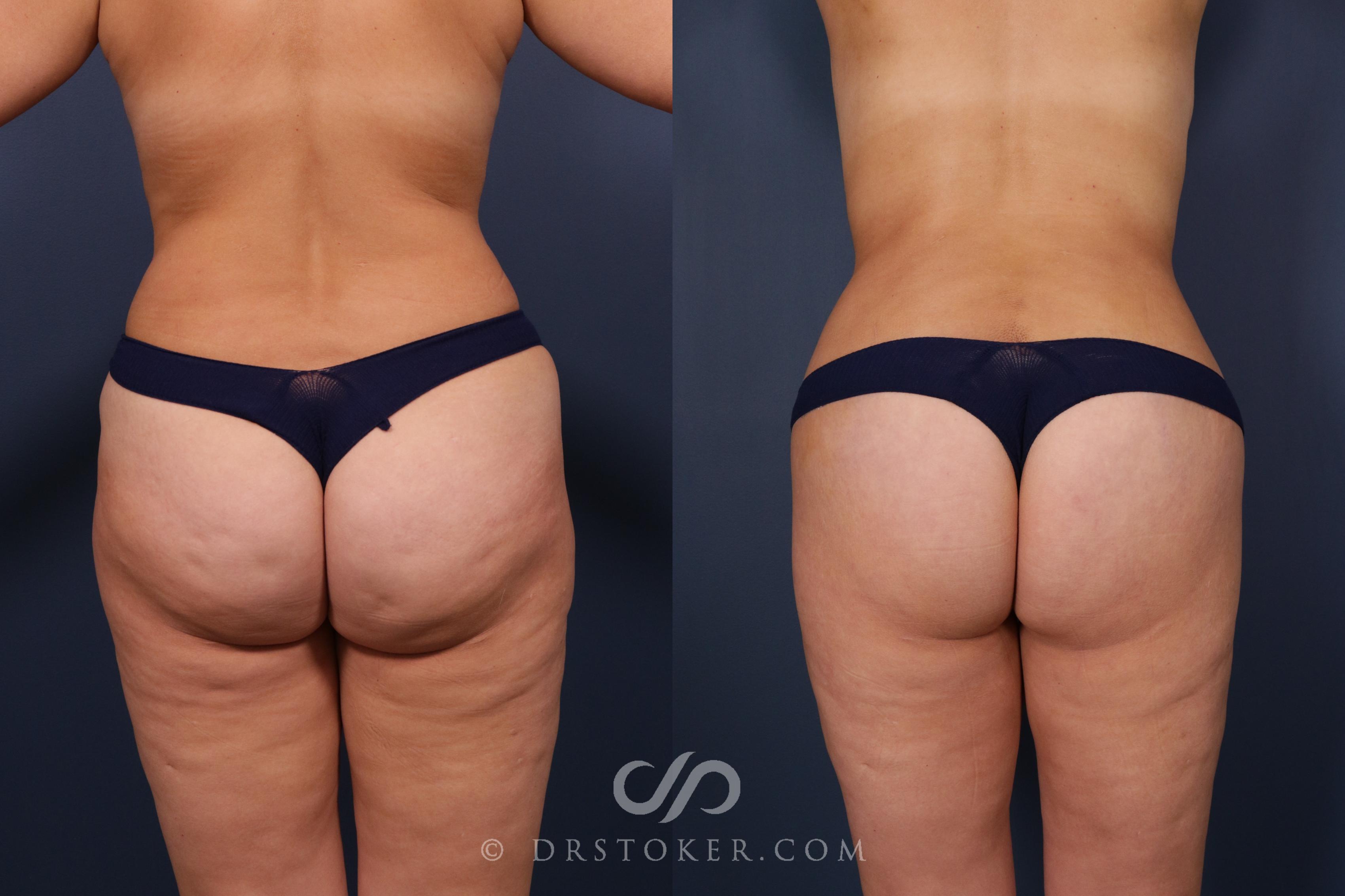 Before & After Bikini Body Lift ™ Case 2481 Back View in Los Angeles, CA