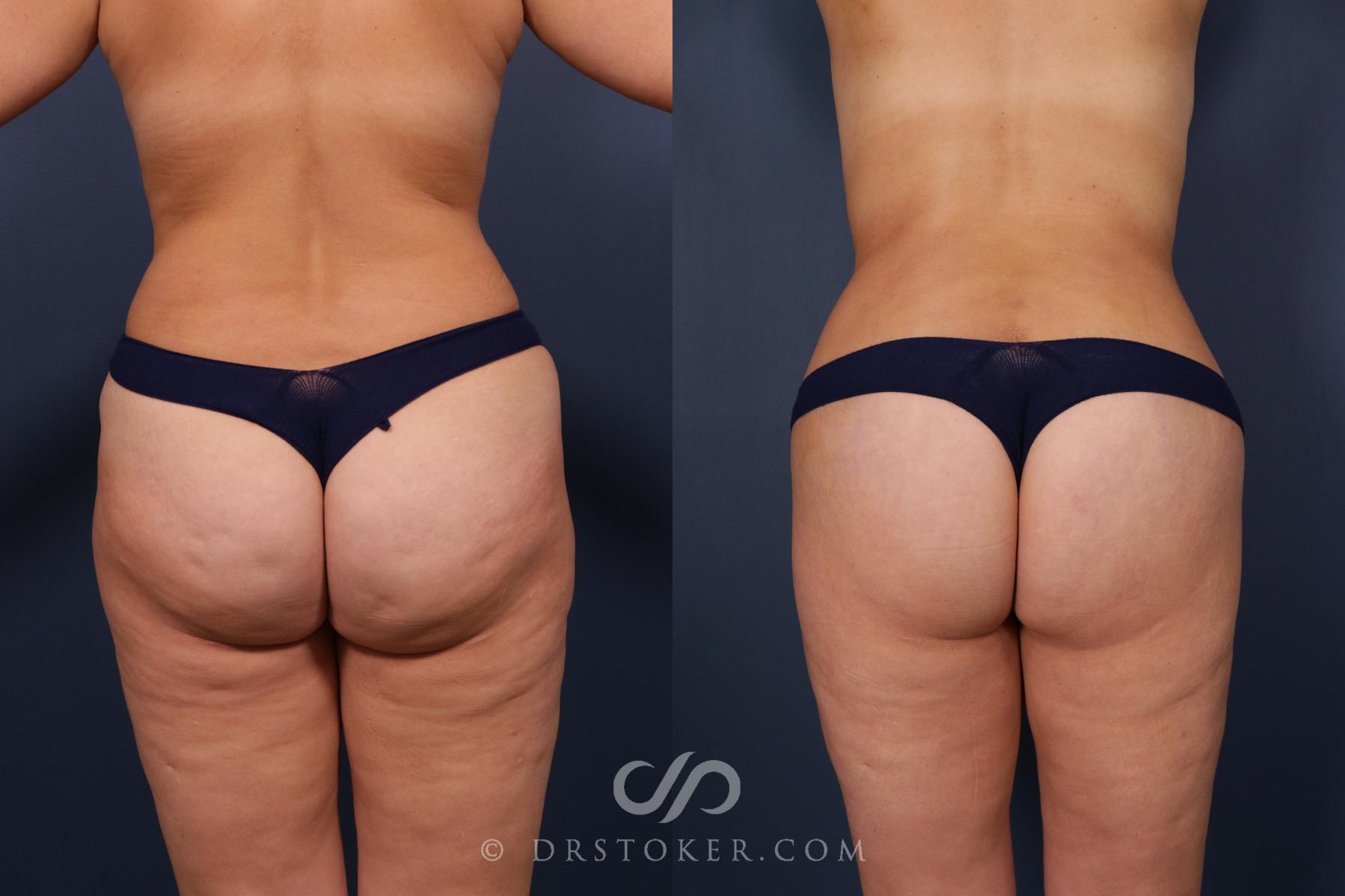 Before & After Bikini Body Lift ™ Case 2481 Back View in Los Angeles, CA