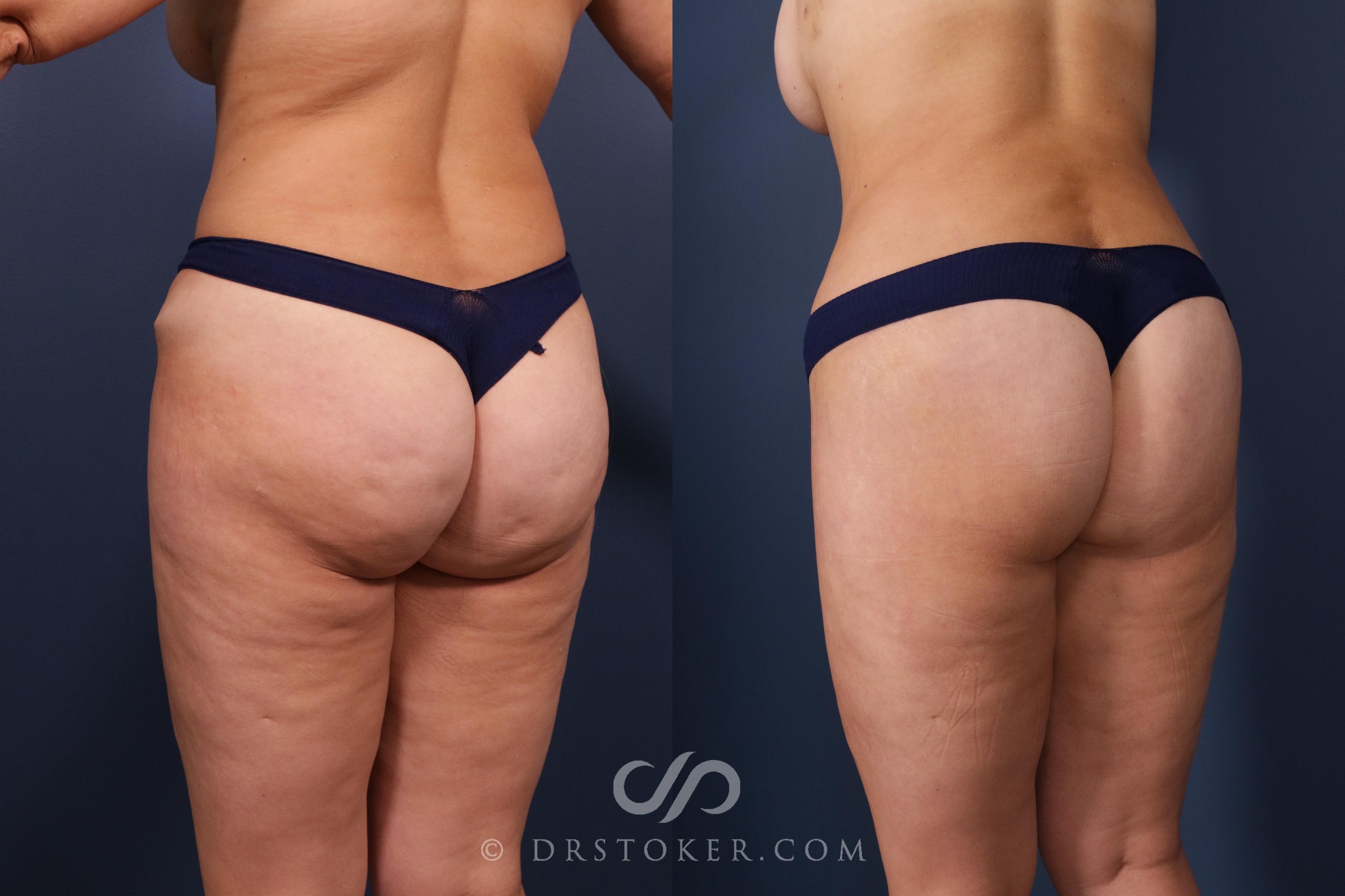 Before & After Bikini Body Lift ™ Case 2481 Left Oblique View in Los Angeles, CA