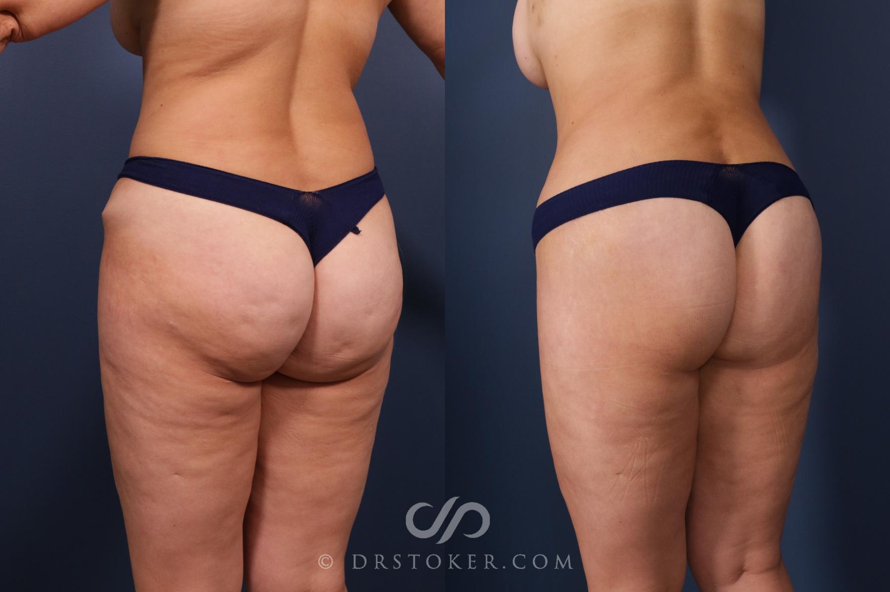 Before & After Bikini Body Lift ™ Case 2481 Left Oblique View in Los Angeles, CA